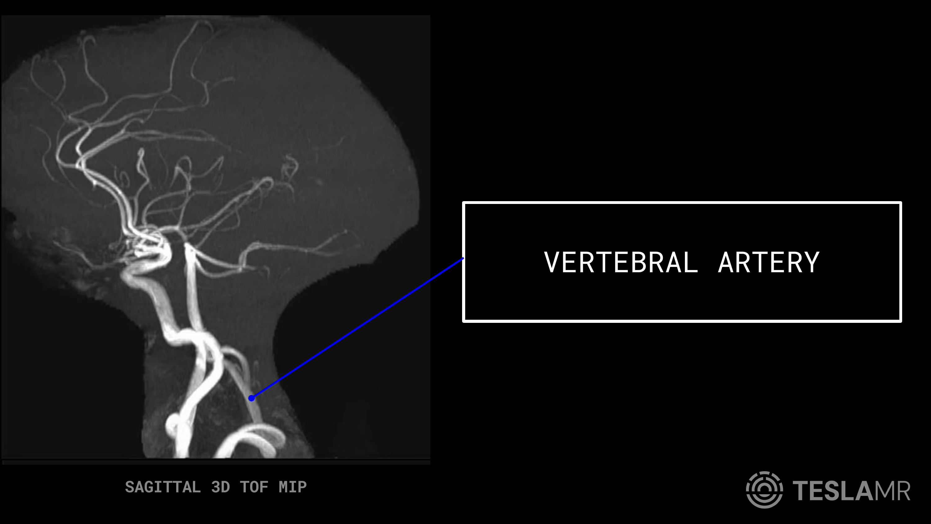 Vertebral Artery labeled on a Head / COW MRI (Sagittal)