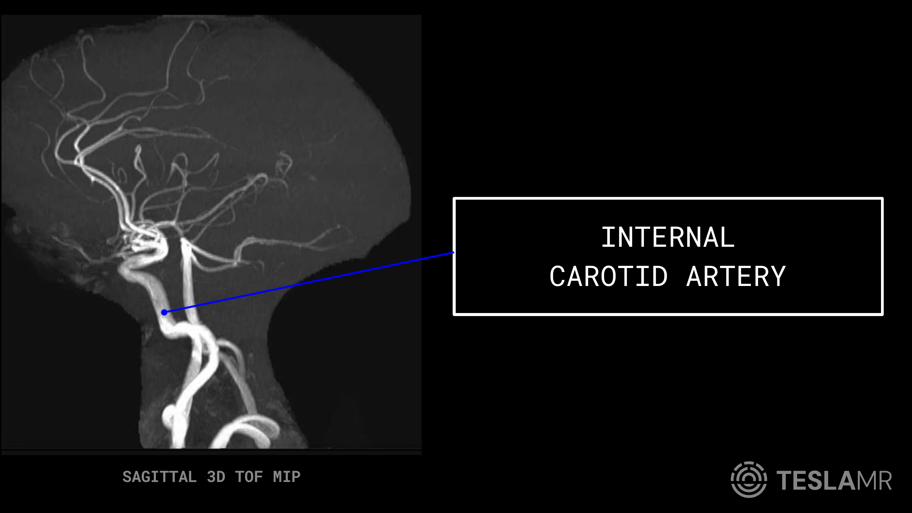 Internal Carotid Artery labeled on a Head / COW MRI (Sagittal)