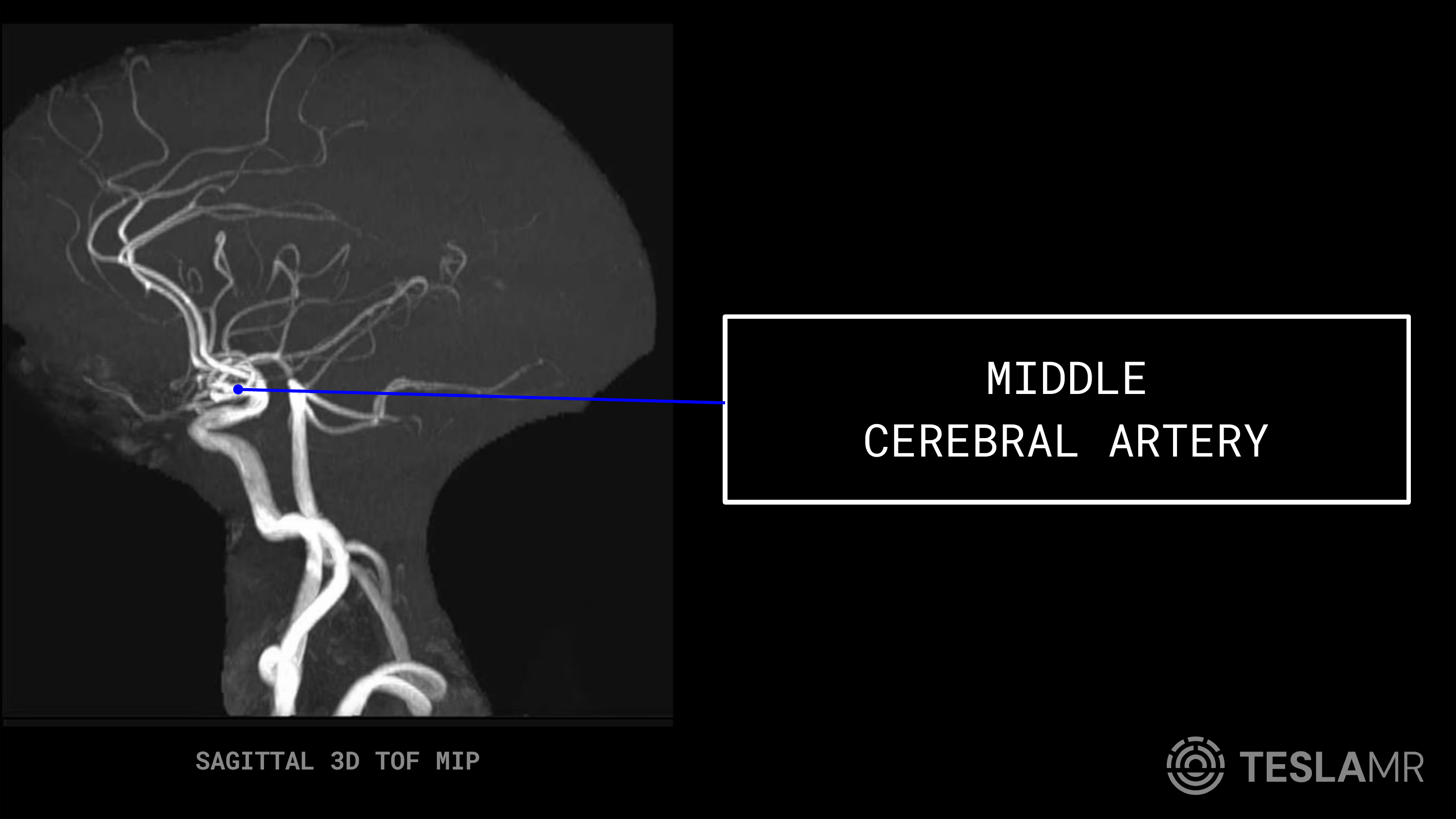 Middle Cerebral Artery labeled on a Head / COW MRI (Sagittal)