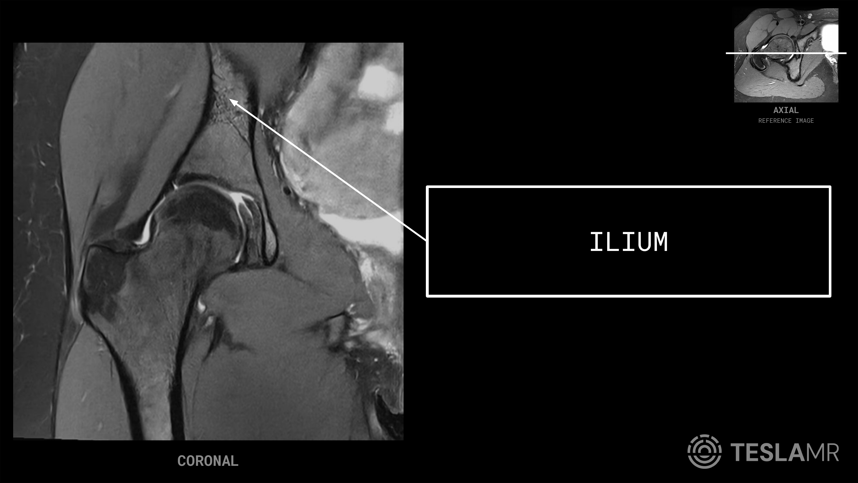 Ilium labeled on a Hips MRI (Coronal)