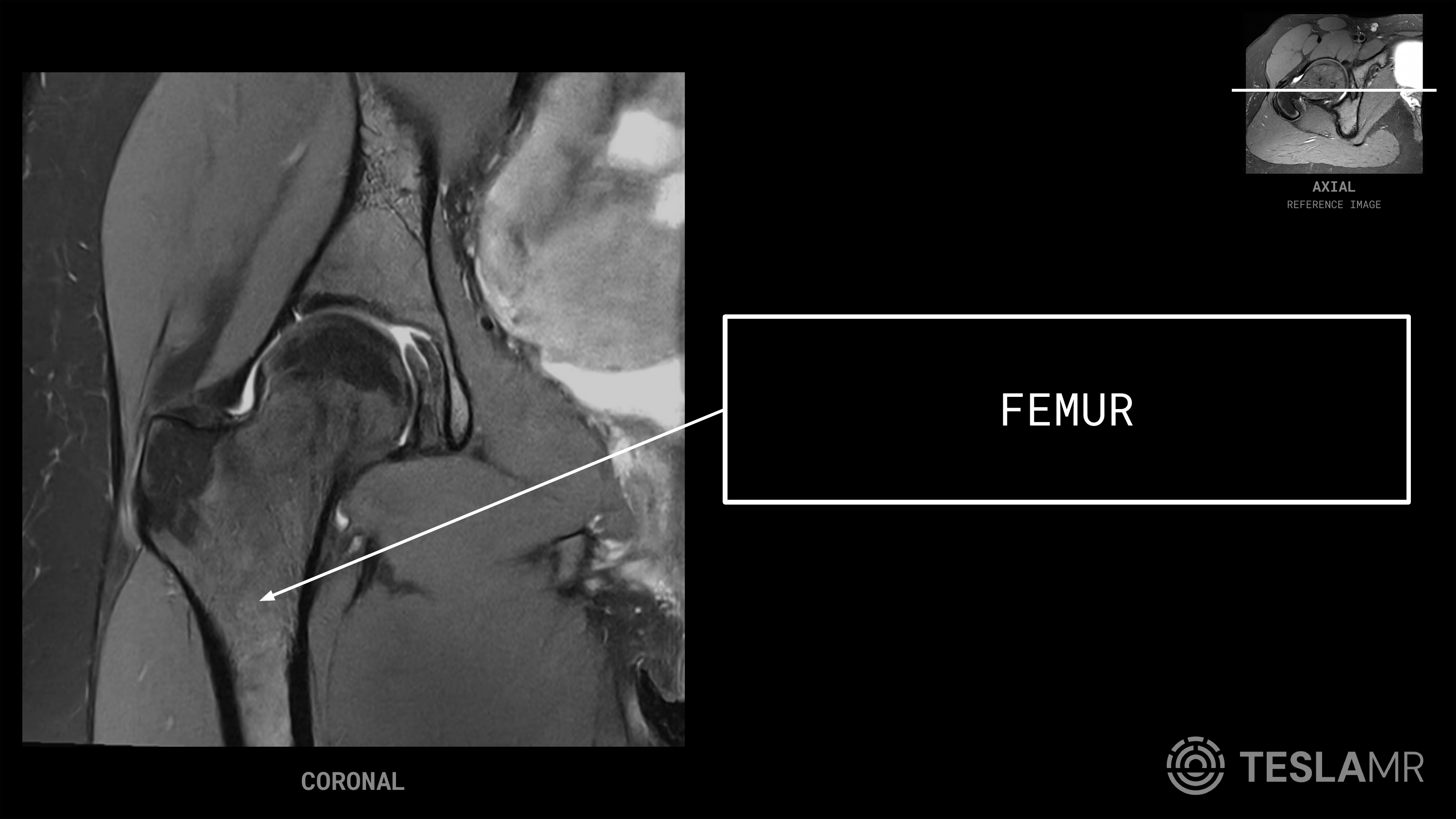 Femur labeled on a Hips MRI (Coronal)