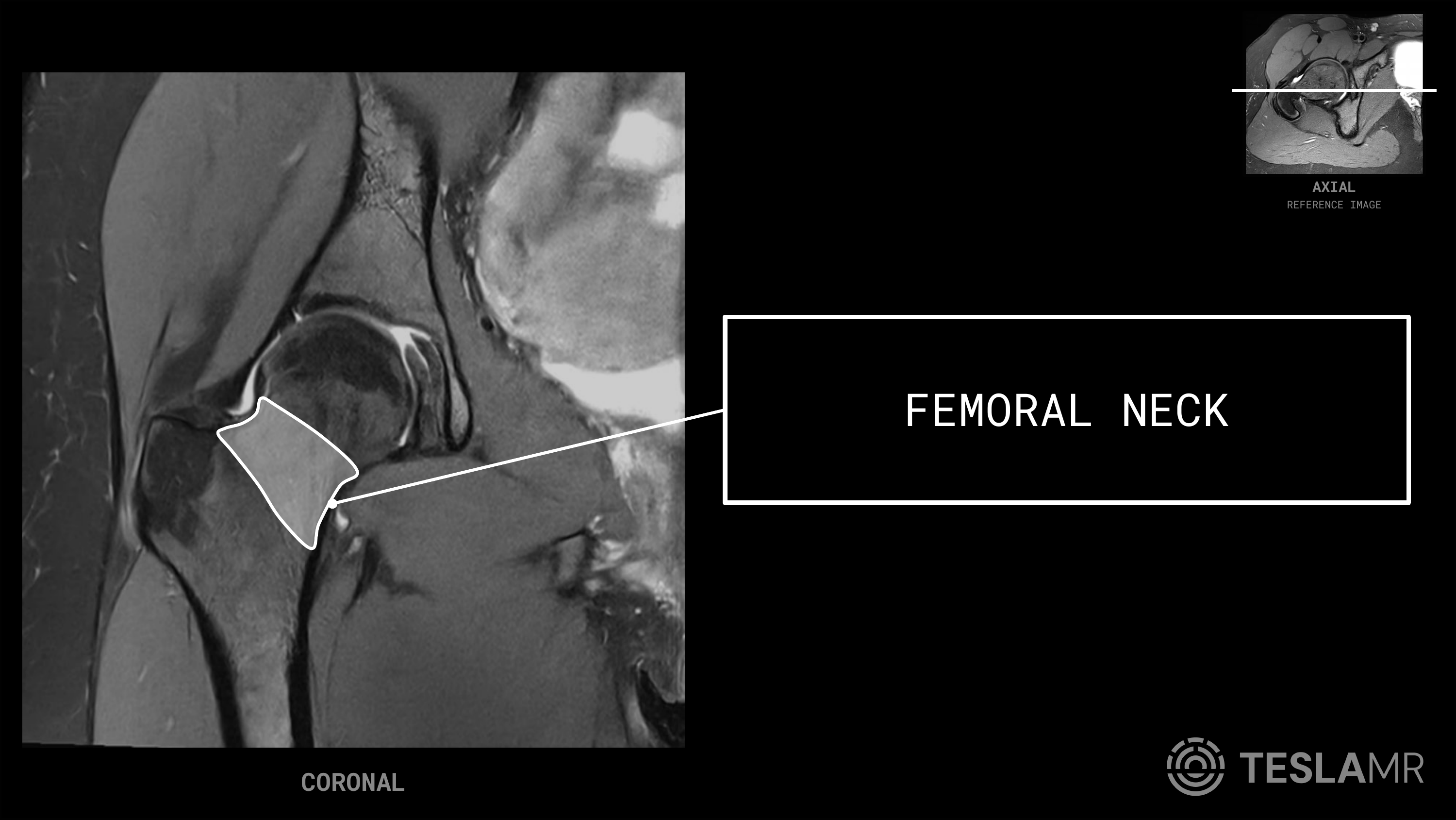 Femoral Neck labeled on a Hips MRI (Coronal · Axial)