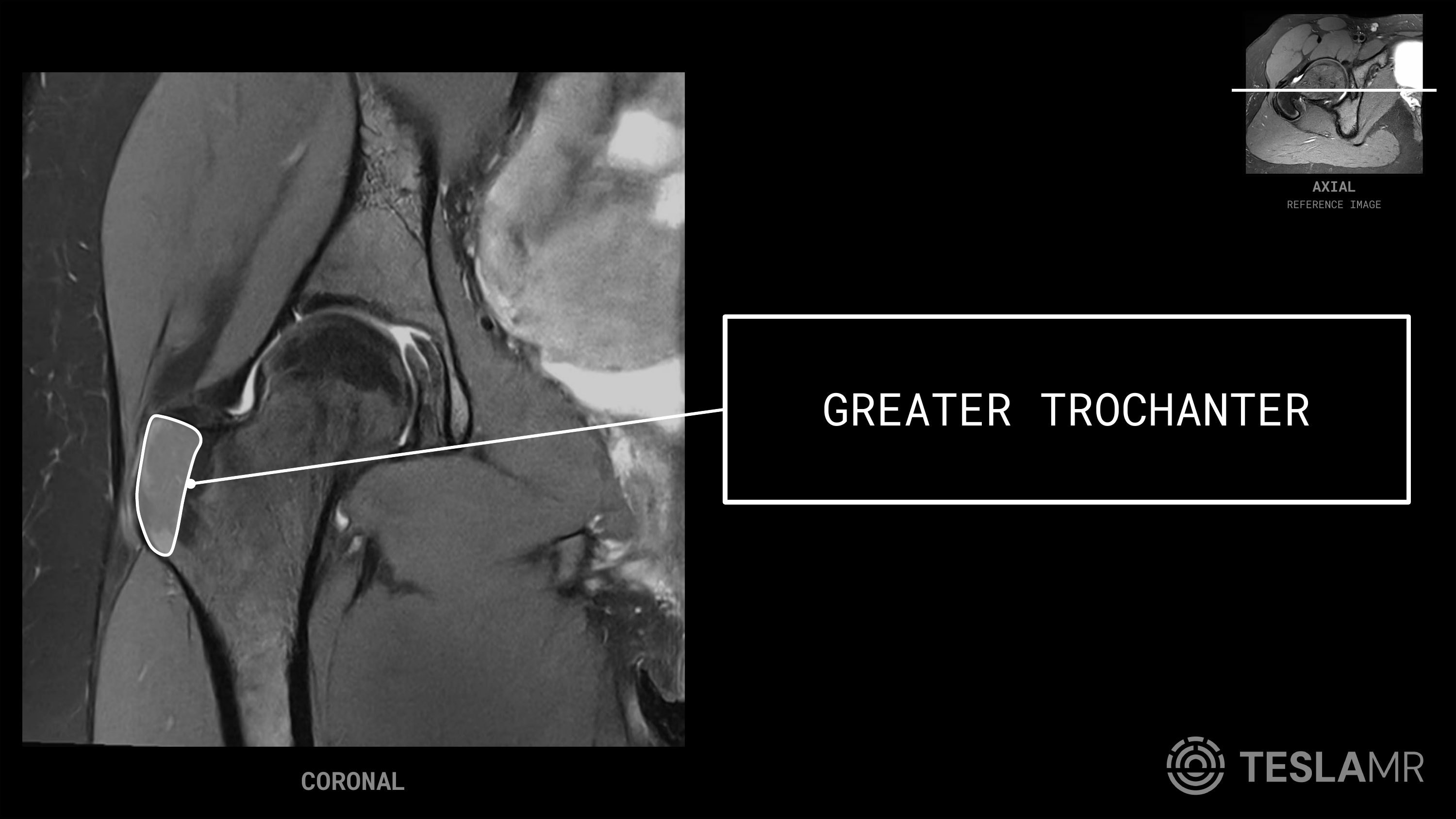 Greater Trochanter labeled on a Hips MRI (Coronal · Axial)
