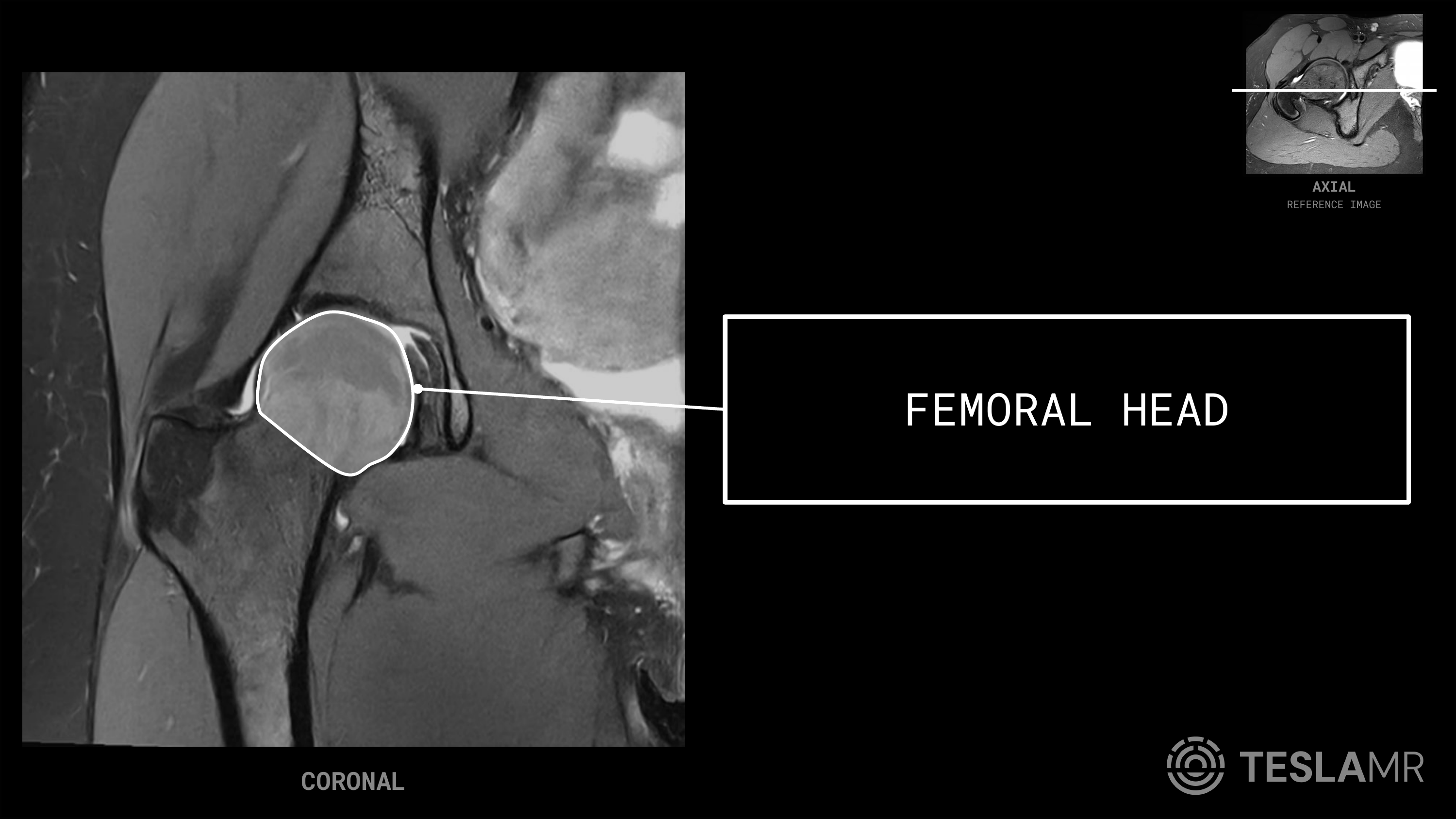 Femoral Head labeled on a Hips MRI (Coronal · Axial)