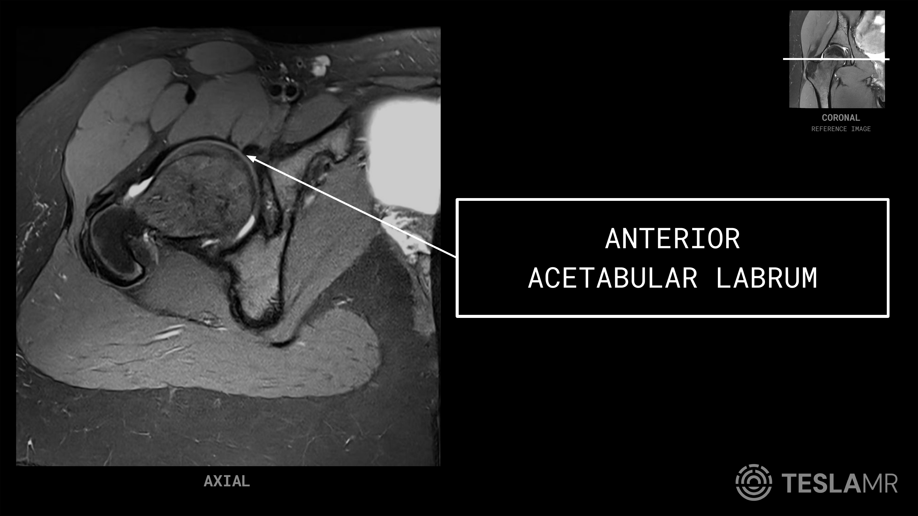 Anterior Acetabular Labrum labeled on a Hips MRI (Axial)