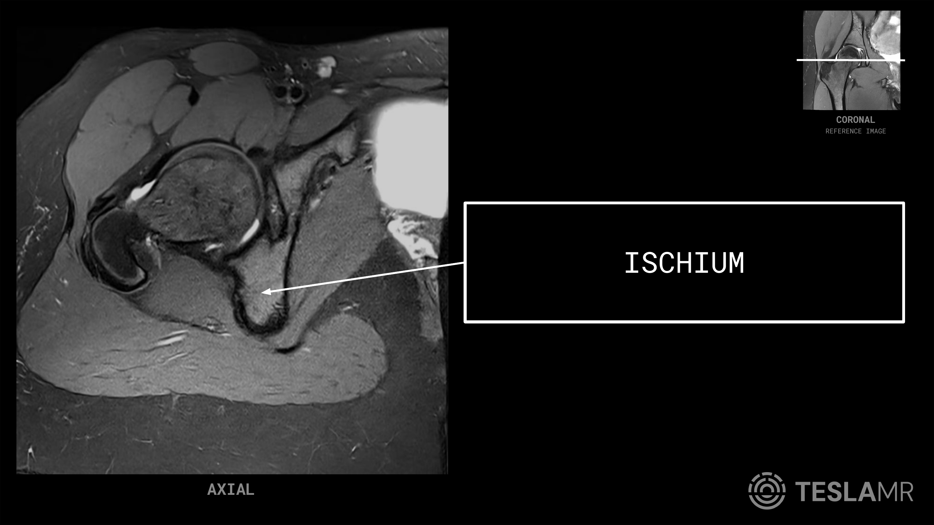 Ischium labeled on a Hips MRI (Axial)