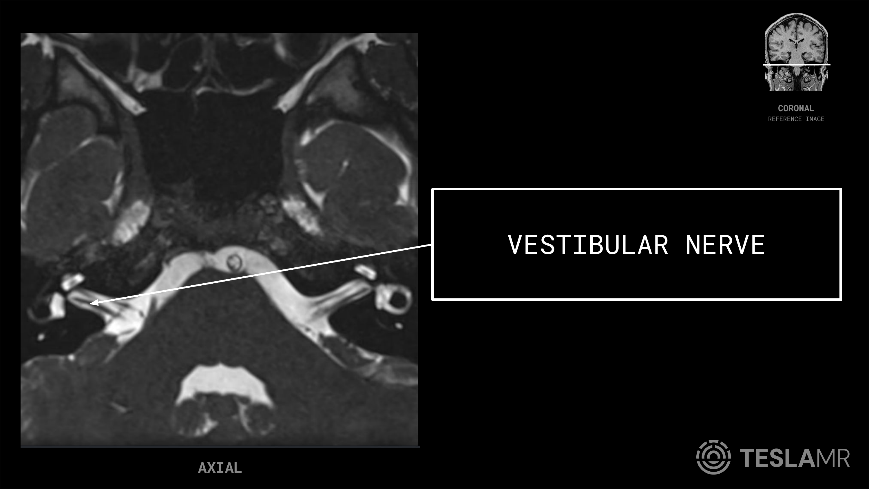 Vestibular Nerve labeled on a IACs MRI (Axial)
