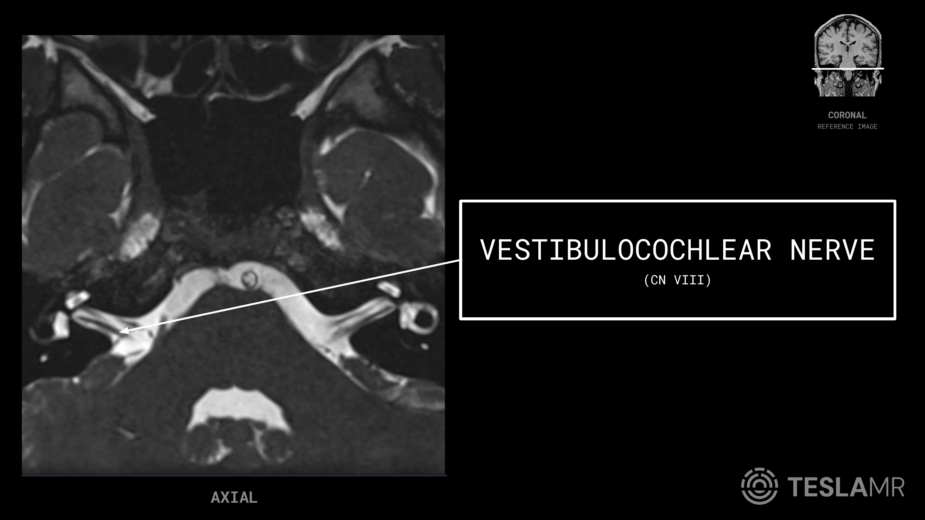 Vestibulocochlear Nerve (CN VIII) labeled on a IACs MRI (Axial · Coronal)