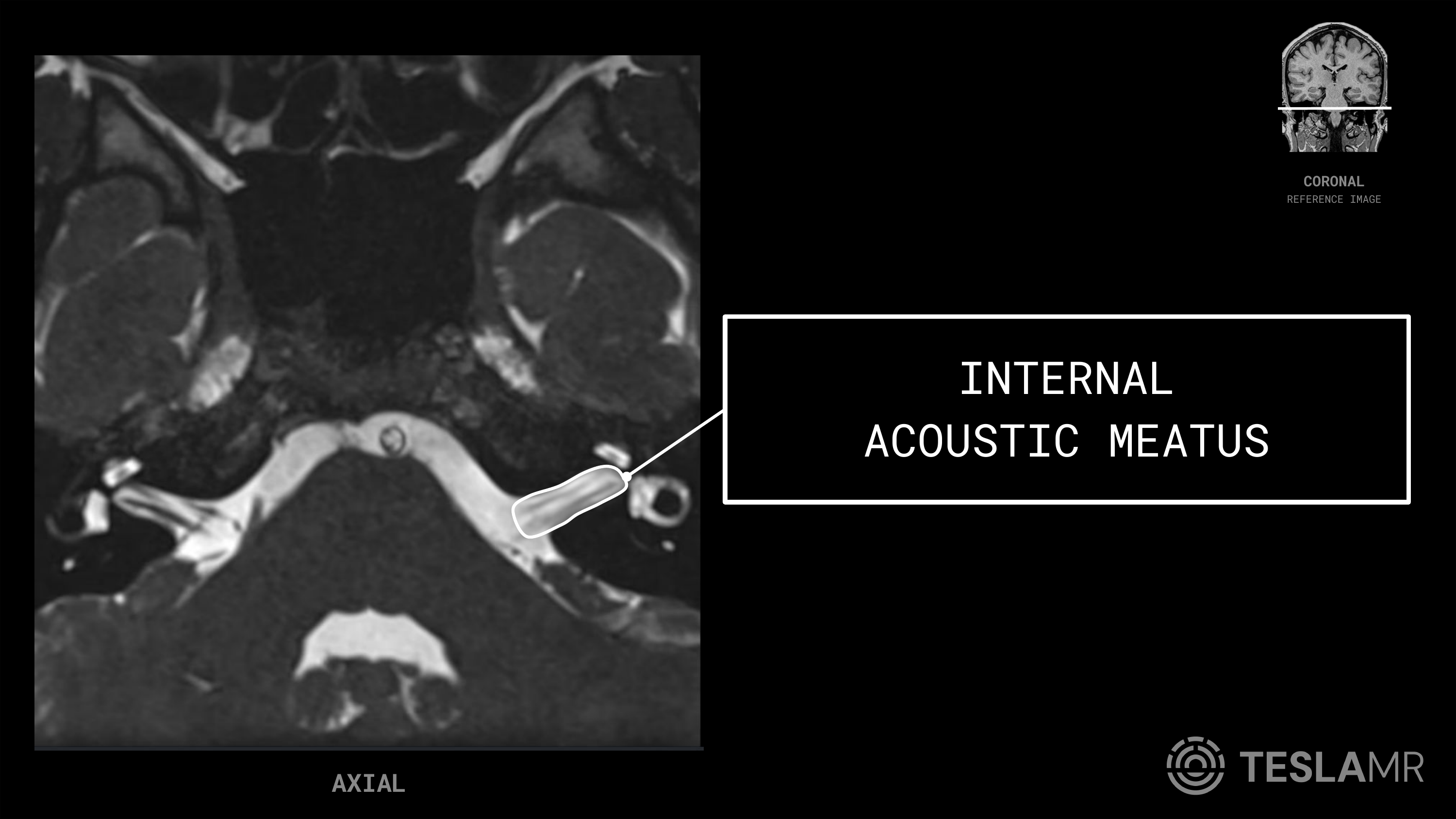 Internal Acoustic Meatus labeled on a IACs MRI (Axial · Coronal)