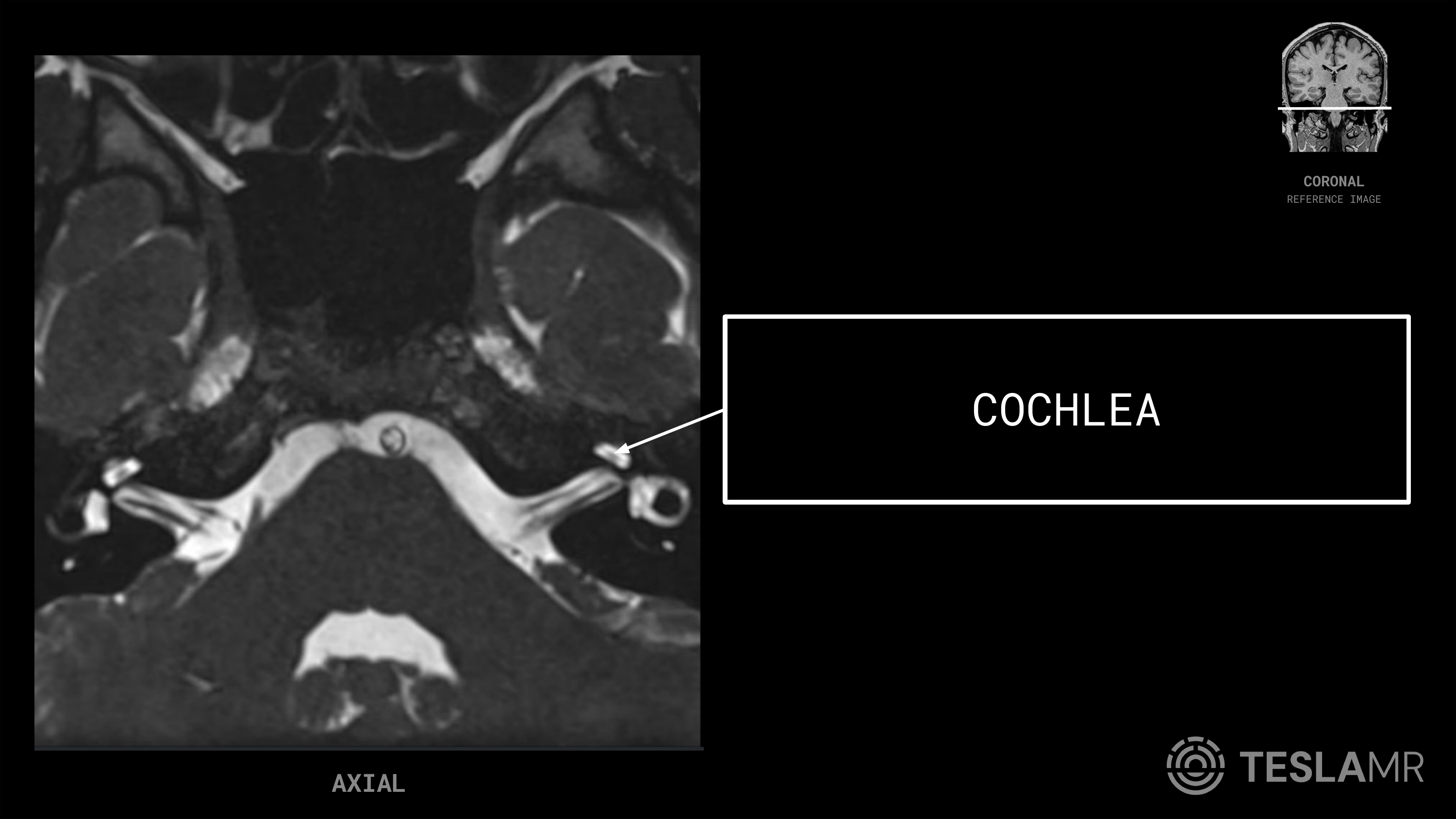 Cochlea labeled on a IACs MRI (Axial)