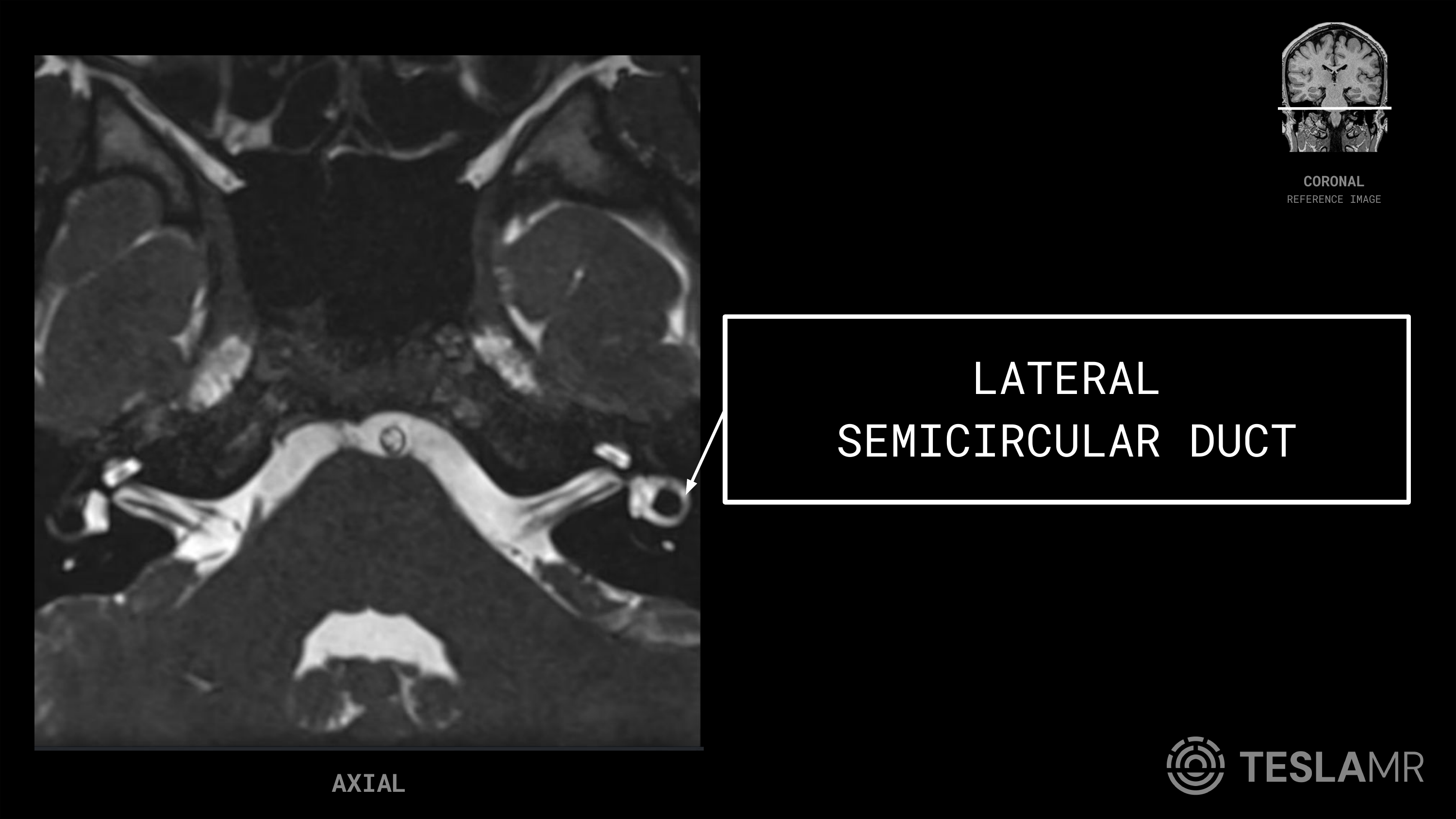 Lateral Semicircular Duct labeled on a IACs MRI (Axial)