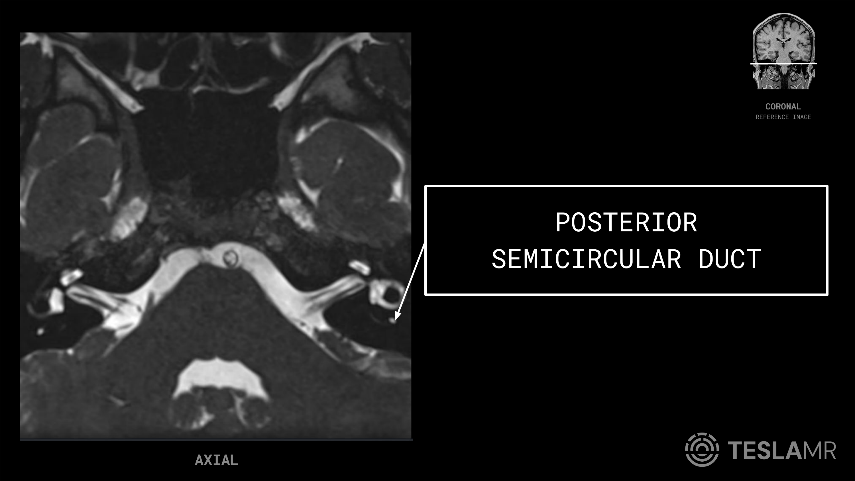 Posterior Semicircular Duct labeled on a IACs MRI (Axial)