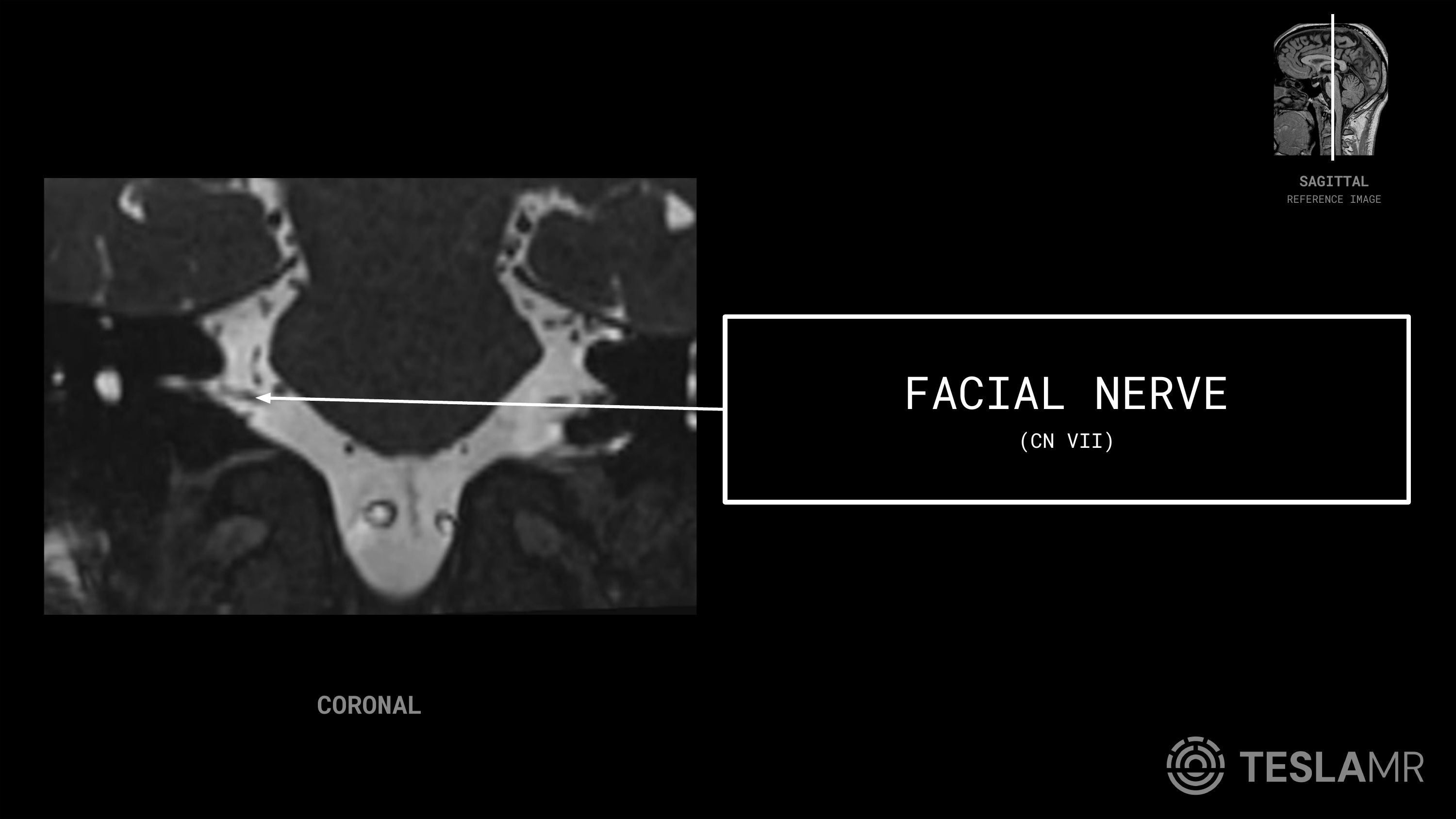 Facial Nerve (CN VII) labeled on a IACs MRI (Coronal)