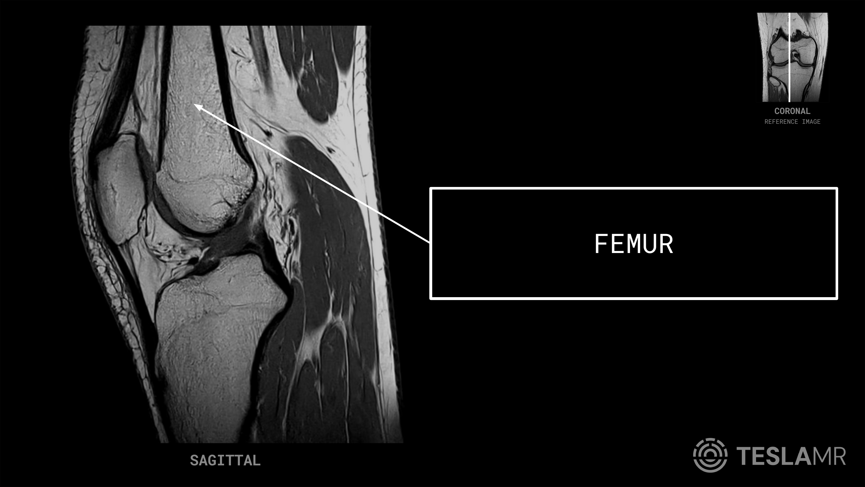 Femur labeled on a Knee MRI (Sagittal · Axial · Coronal)