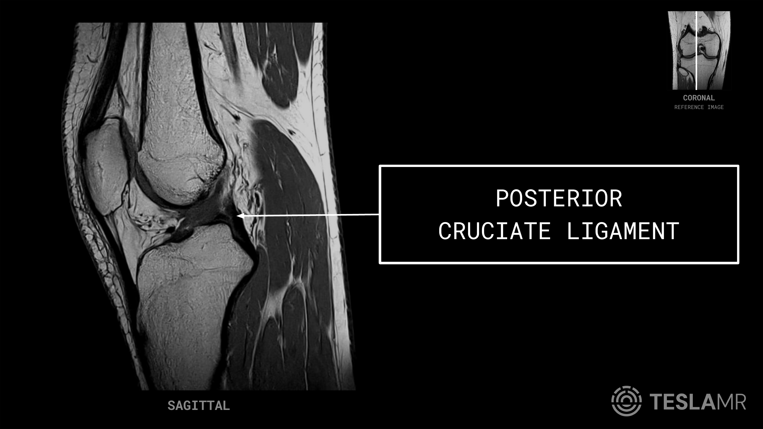 Posterior Cruciate Ligament labeled on a Knee MRI (Sagittal · Coronal)