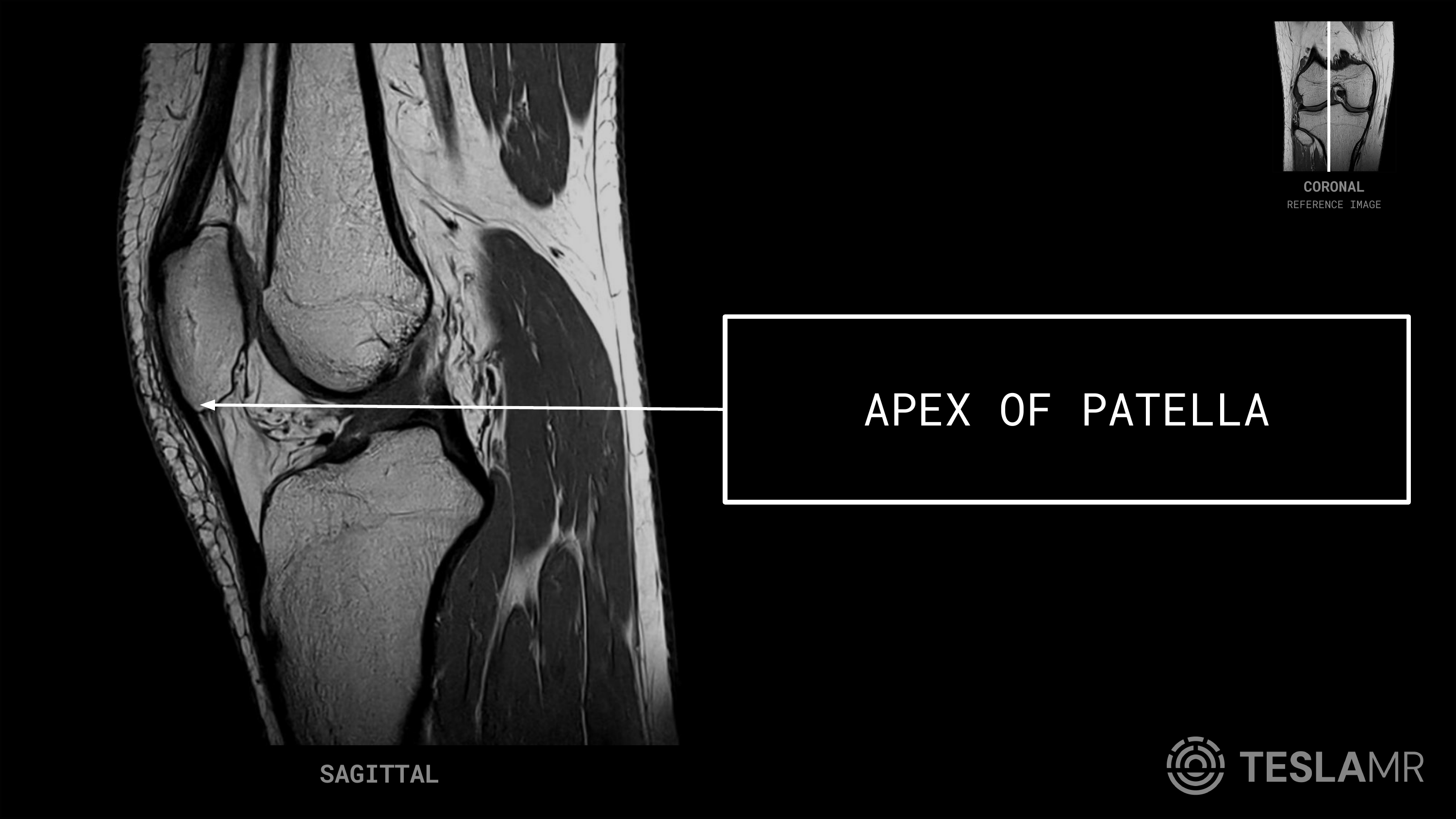 Apex of Patella labeled on a Knee MRI (Sagittal)