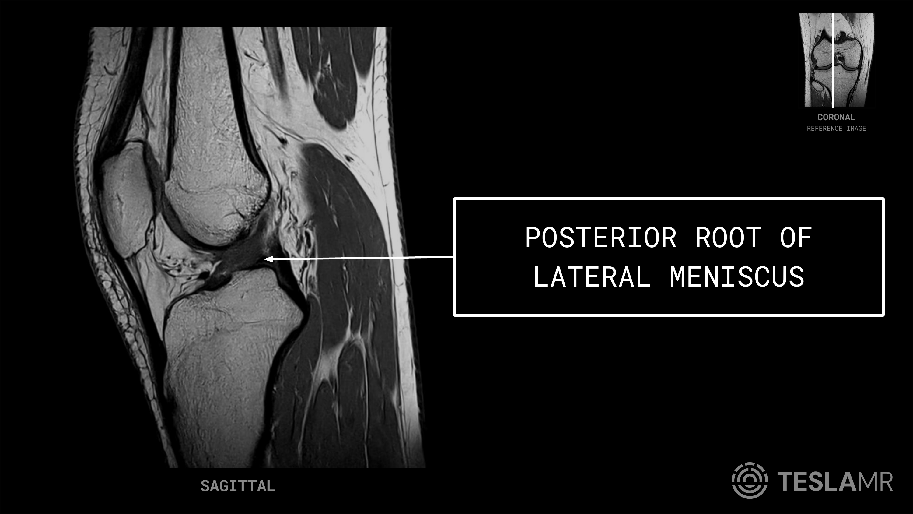 Posterior Root of Lateral Meniscus labeled on a Knee MRI (Sagittal)