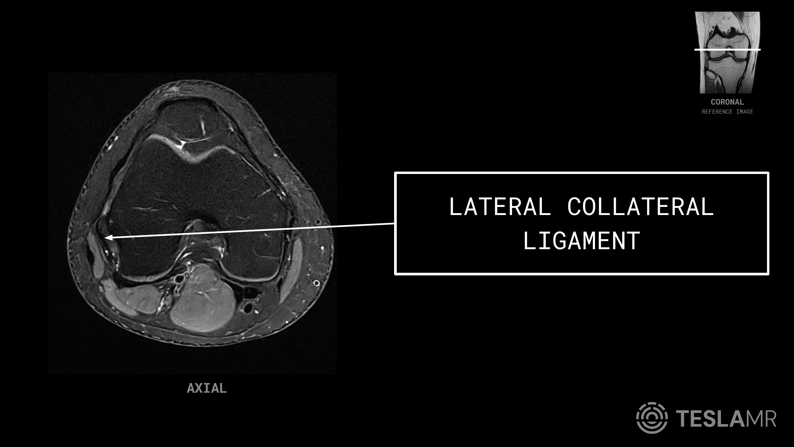 Lateral Collateral Ligament labeled on a Knee MRI (Axial · Coronal)