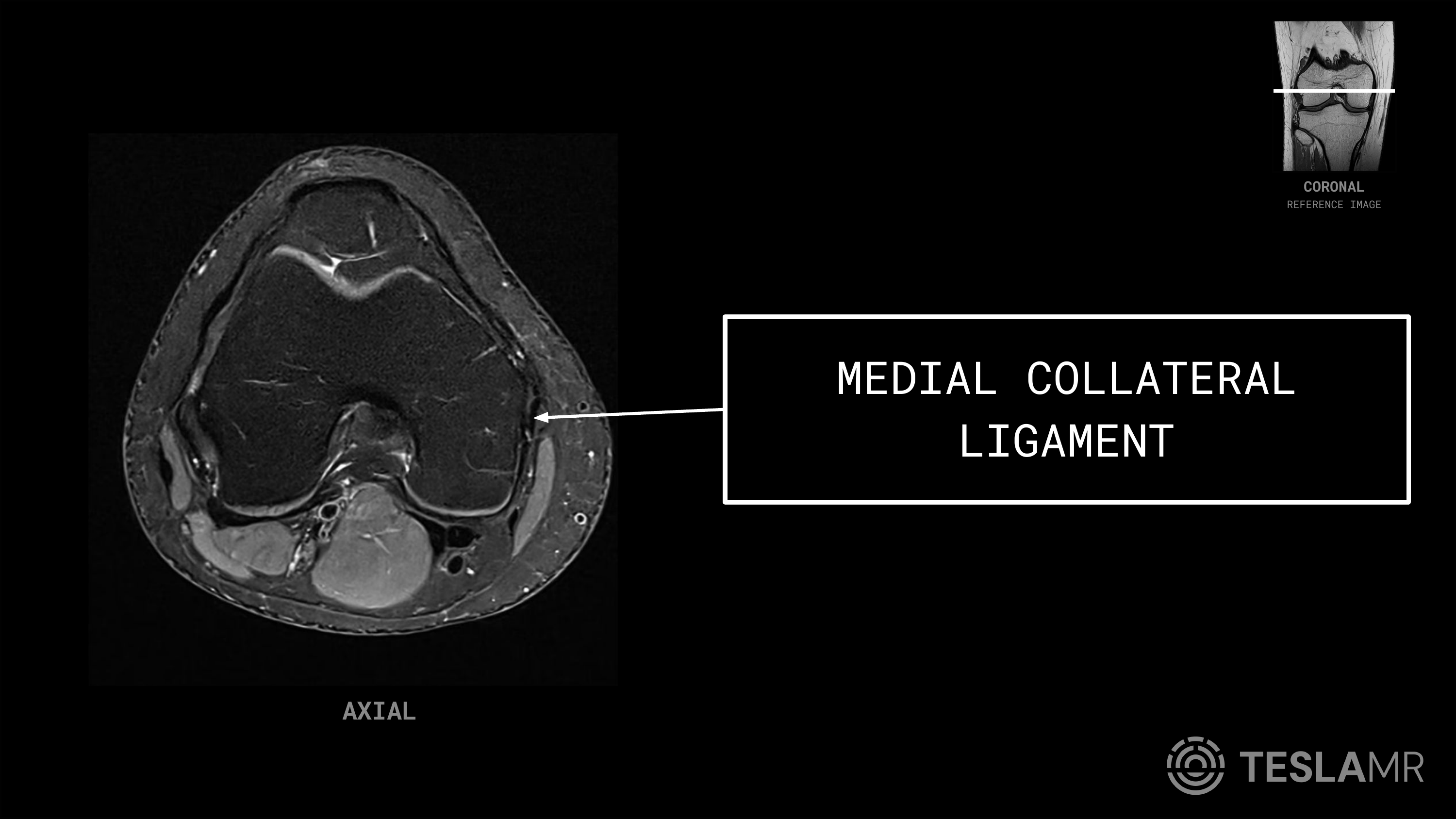 Medial Collateral Ligament labeled on a Knee MRI (Axial · Coronal)