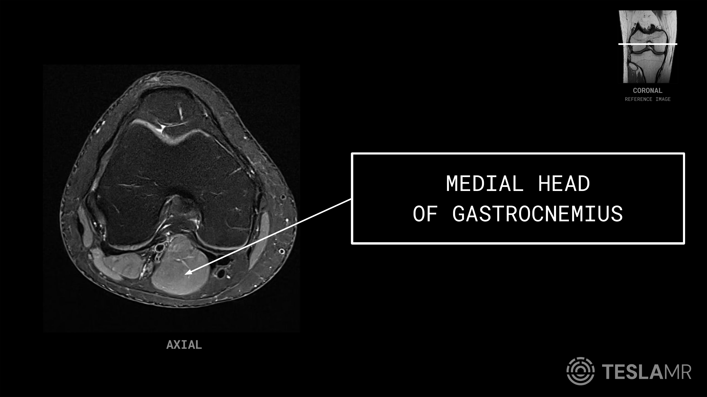 Medial Head labeled on a Knee MRI (Axial)