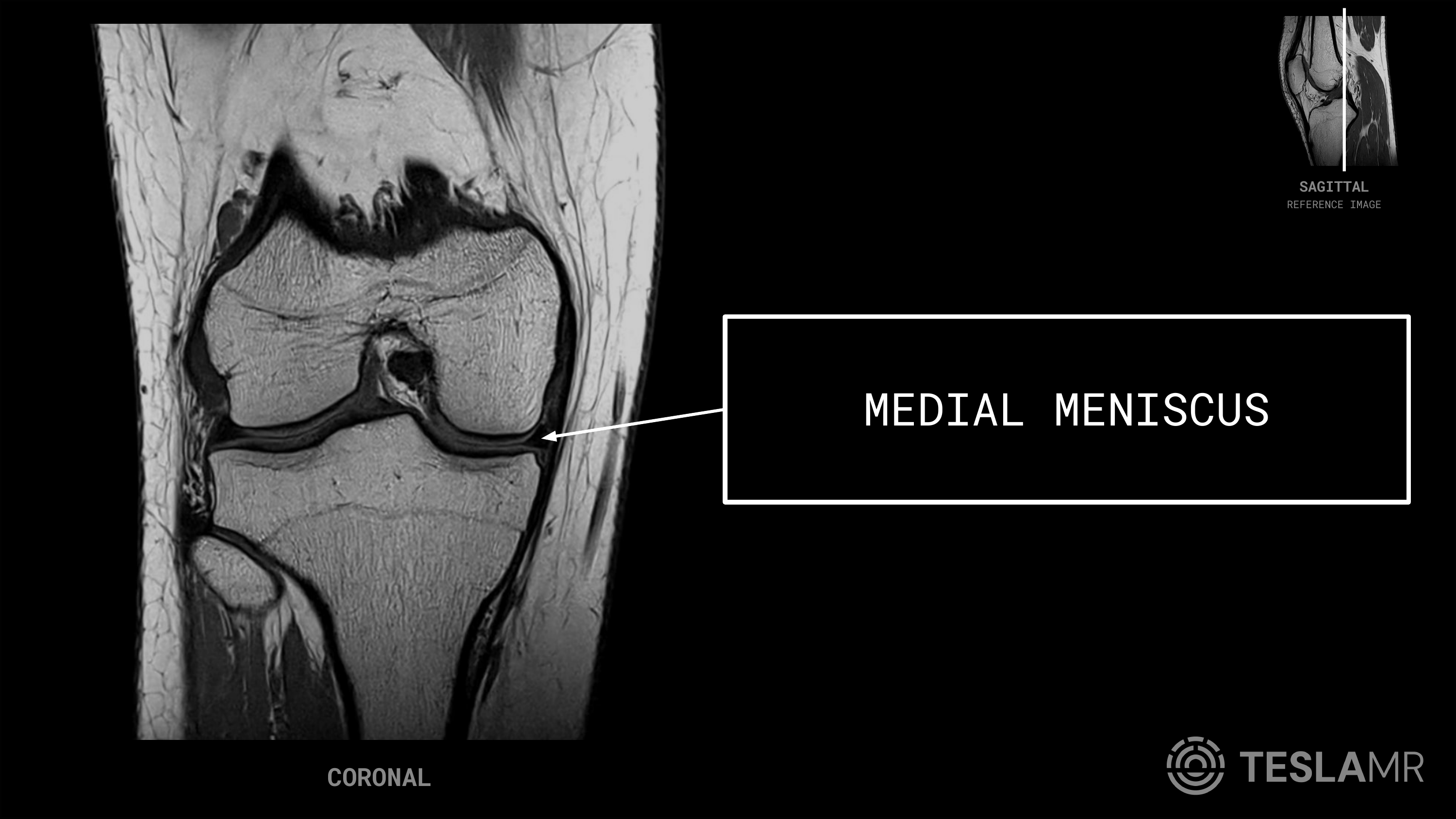 Medial Meniscus labeled on a Knee MRI (Coronal)