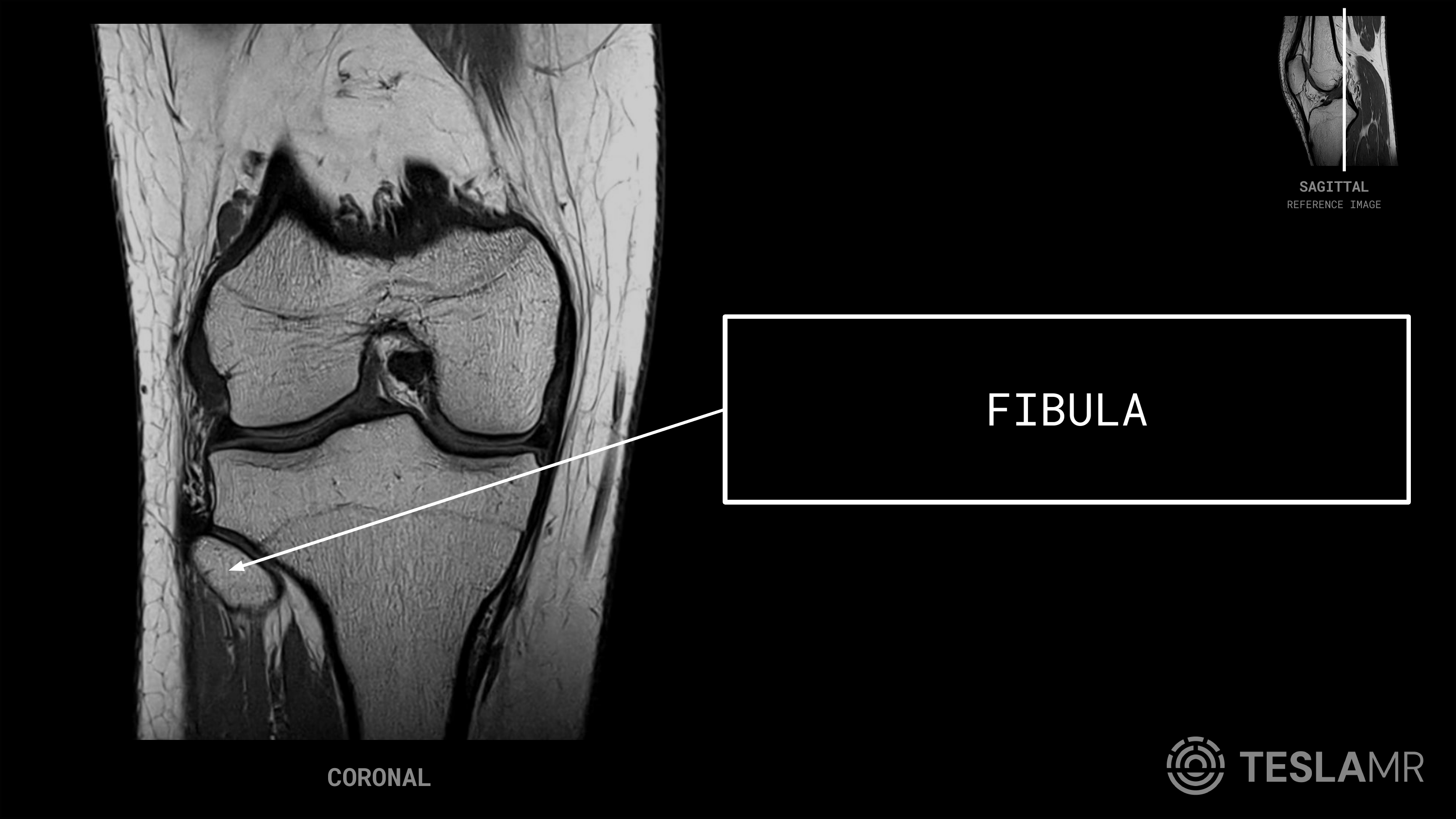 Fibula labeled on a Knee MRI (Coronal)