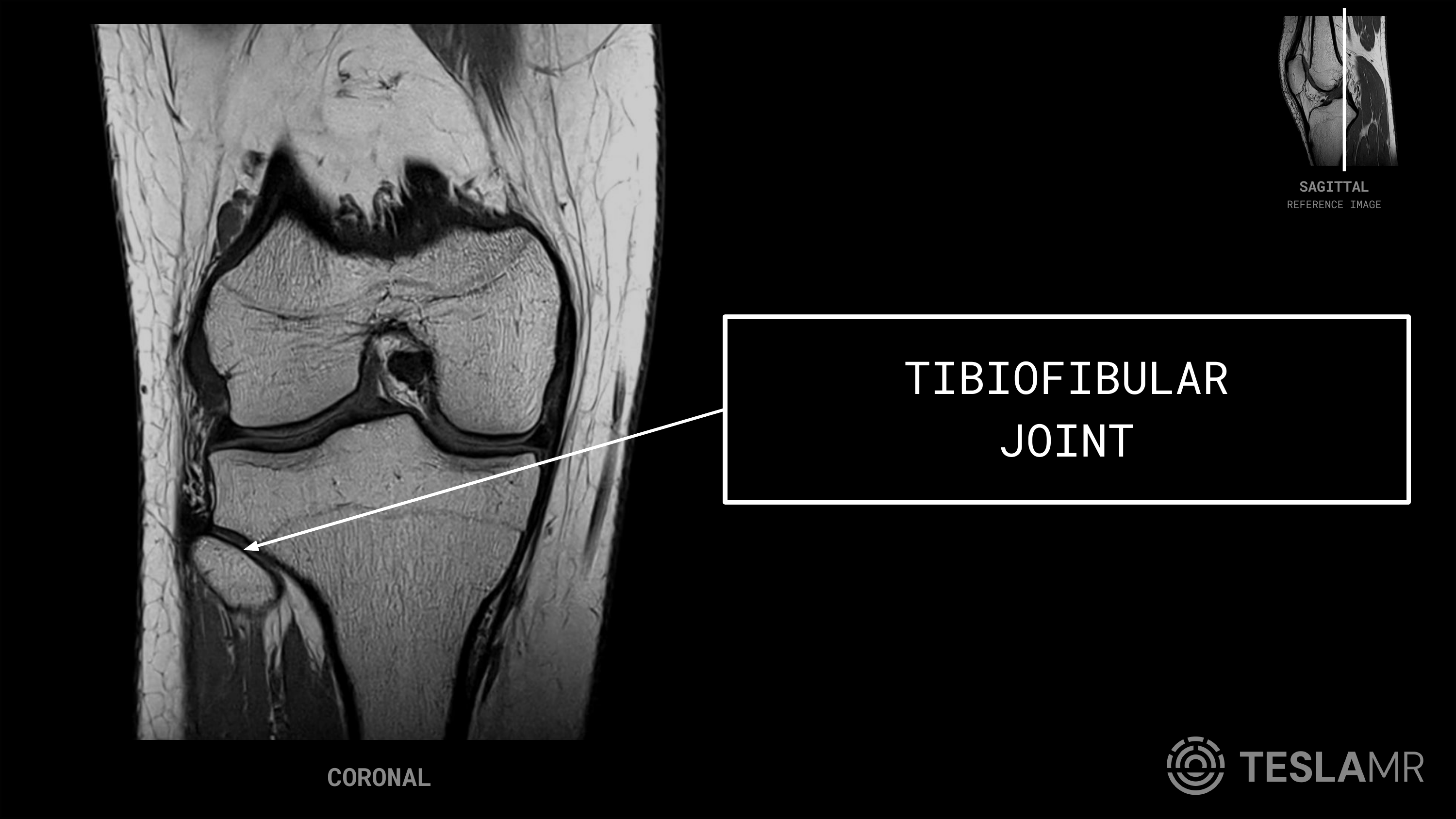 Tibiofibular Joint labeled on a Knee MRI (Coronal)