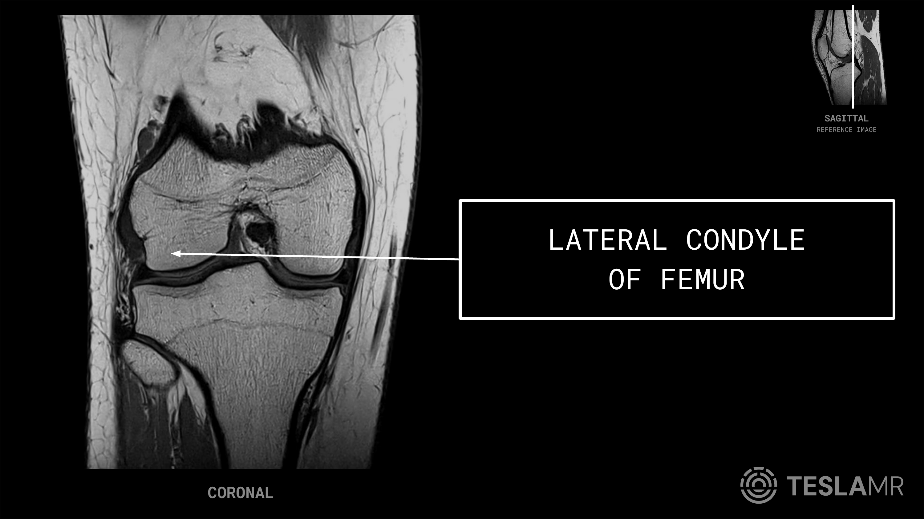 Lateral Condyle labeled on a Knee MRI (Coronal)