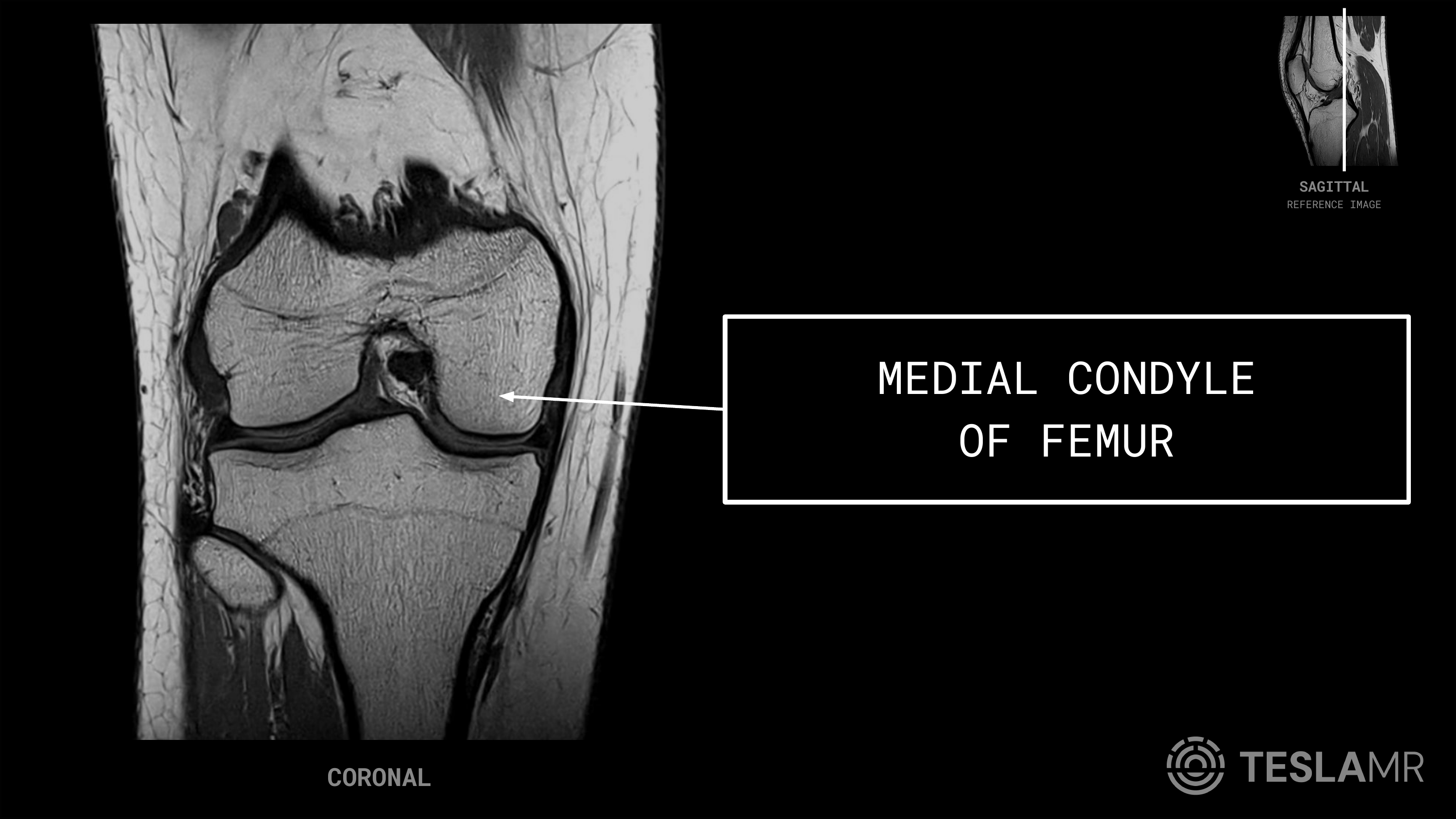 Medial Condyle labeled on a Knee MRI (Coronal)