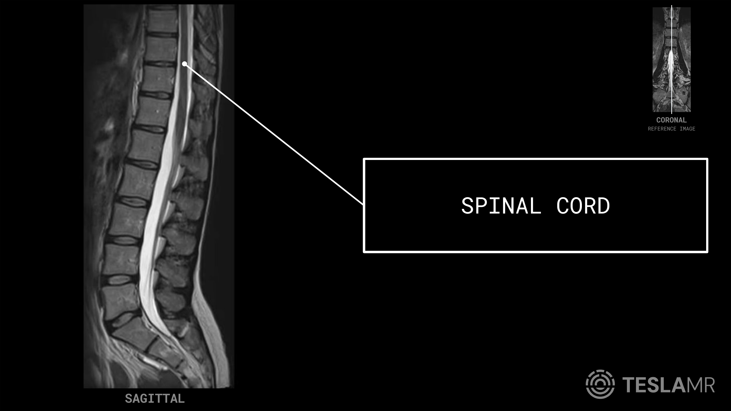 Spinal Cord labeled on a L-Spine MRI (Sagittal · Axial)