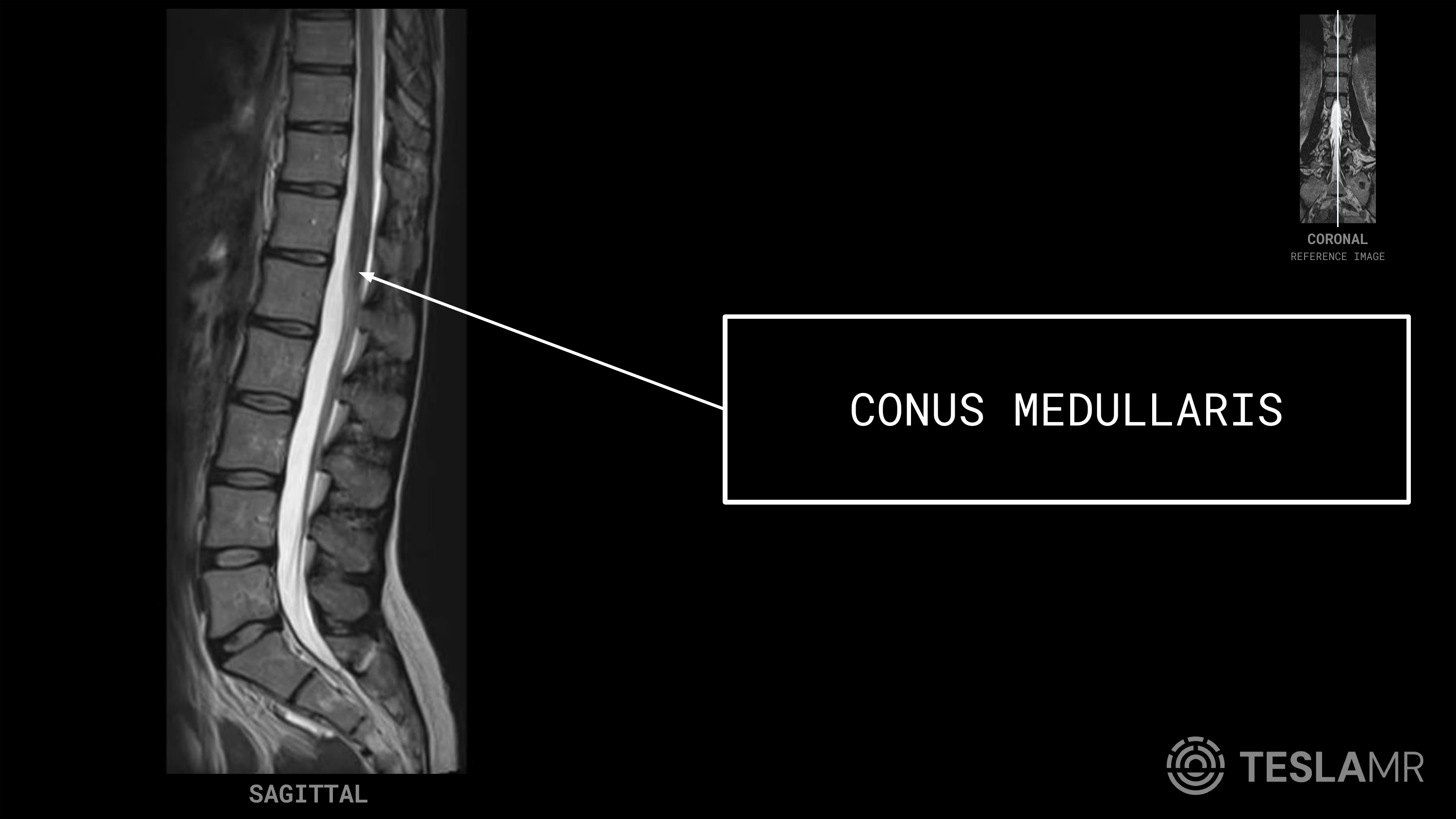 Conus Medullaris labeled on a L-Spine MRI (Sagittal · Axial)