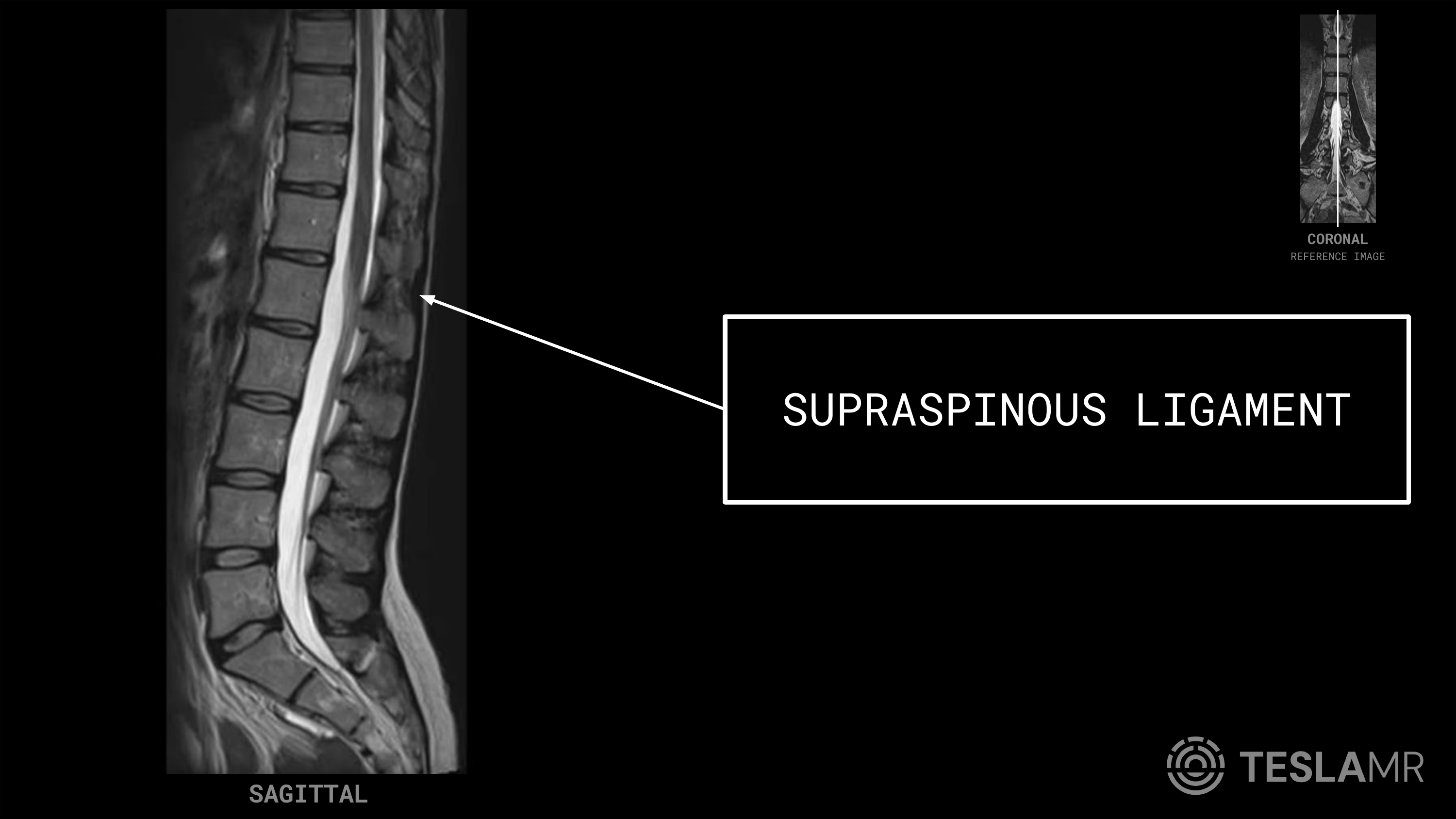 Supraspinous Ligament labeled on a L-Spine MRI (Sagittal)
