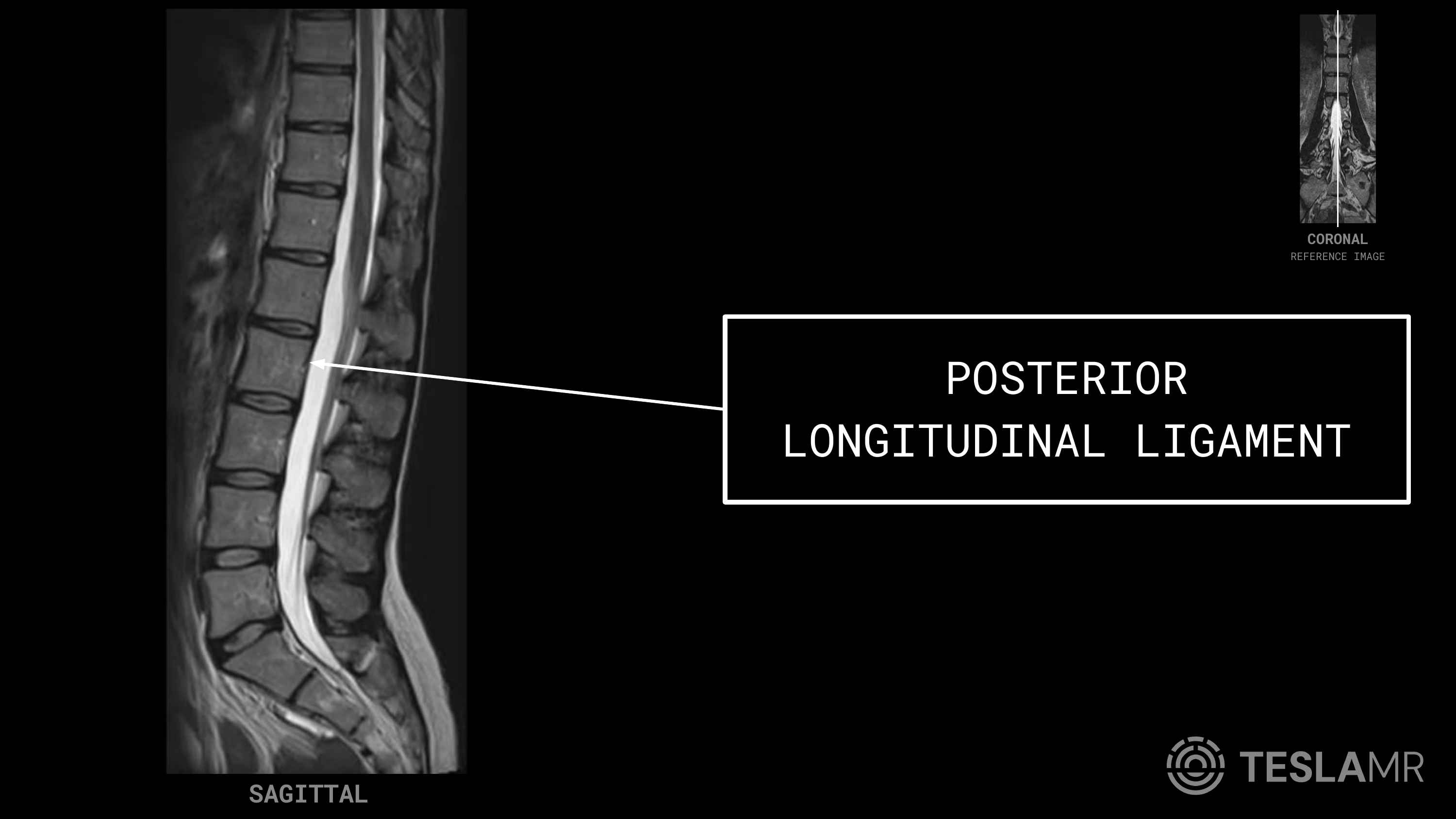 Posterior Longitudinal Ligament labeled on a L-Spine MRI (Sagittal)