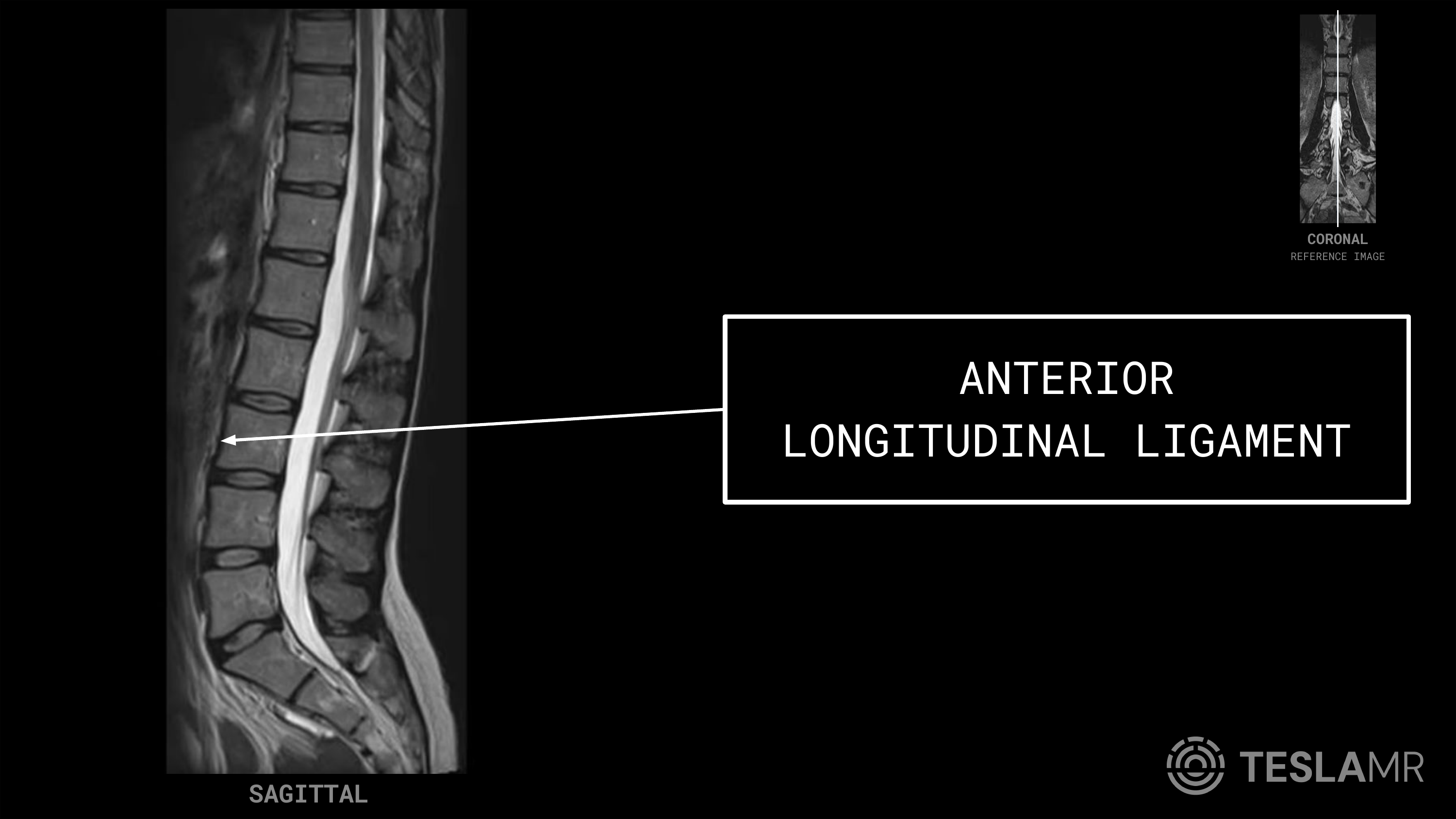 Anterior Longitudinal Ligament labeled on a L-Spine MRI (Sagittal)