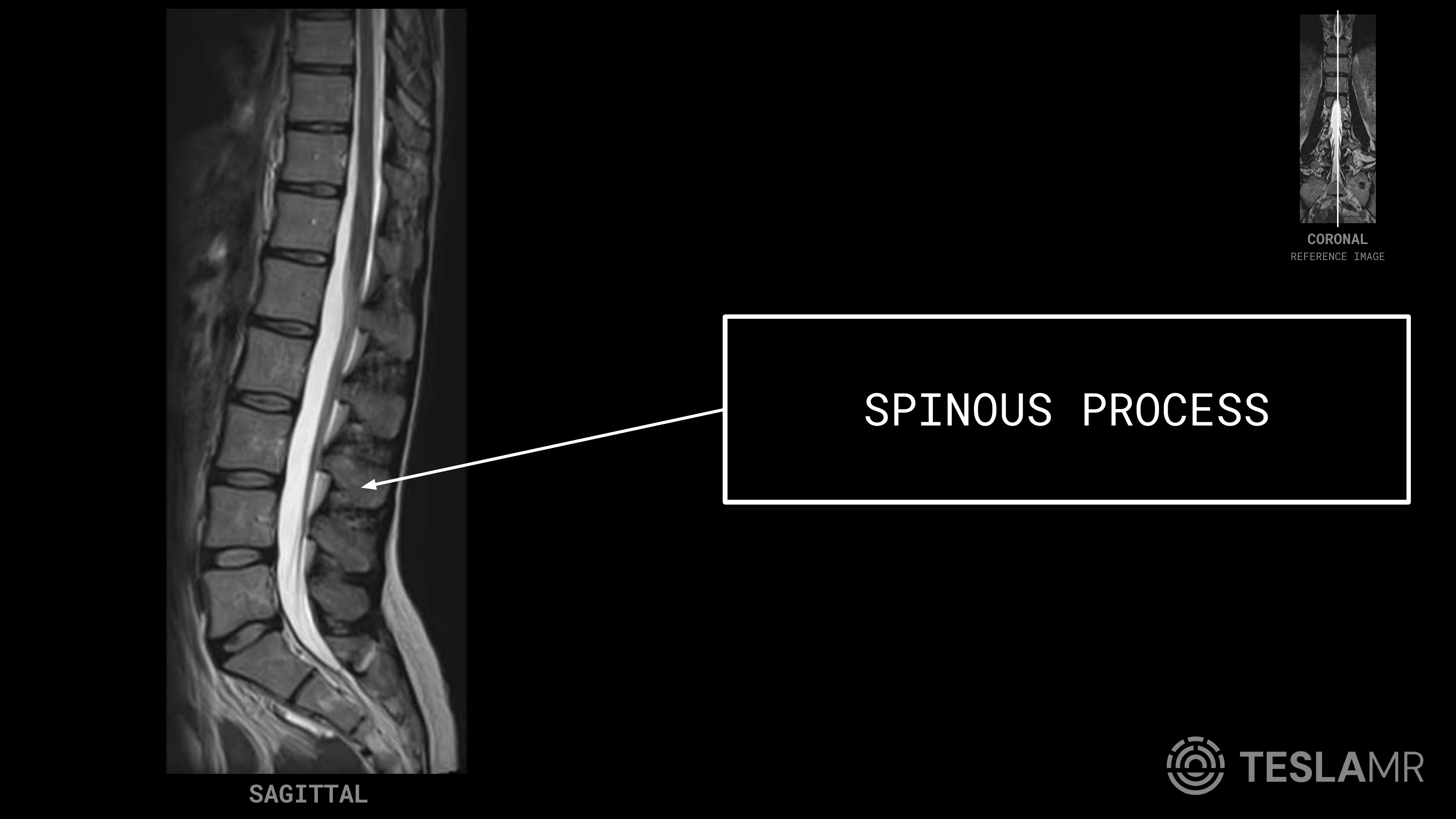 Spinous Process labeled on a L-Spine MRI (Sagittal · Axial)
