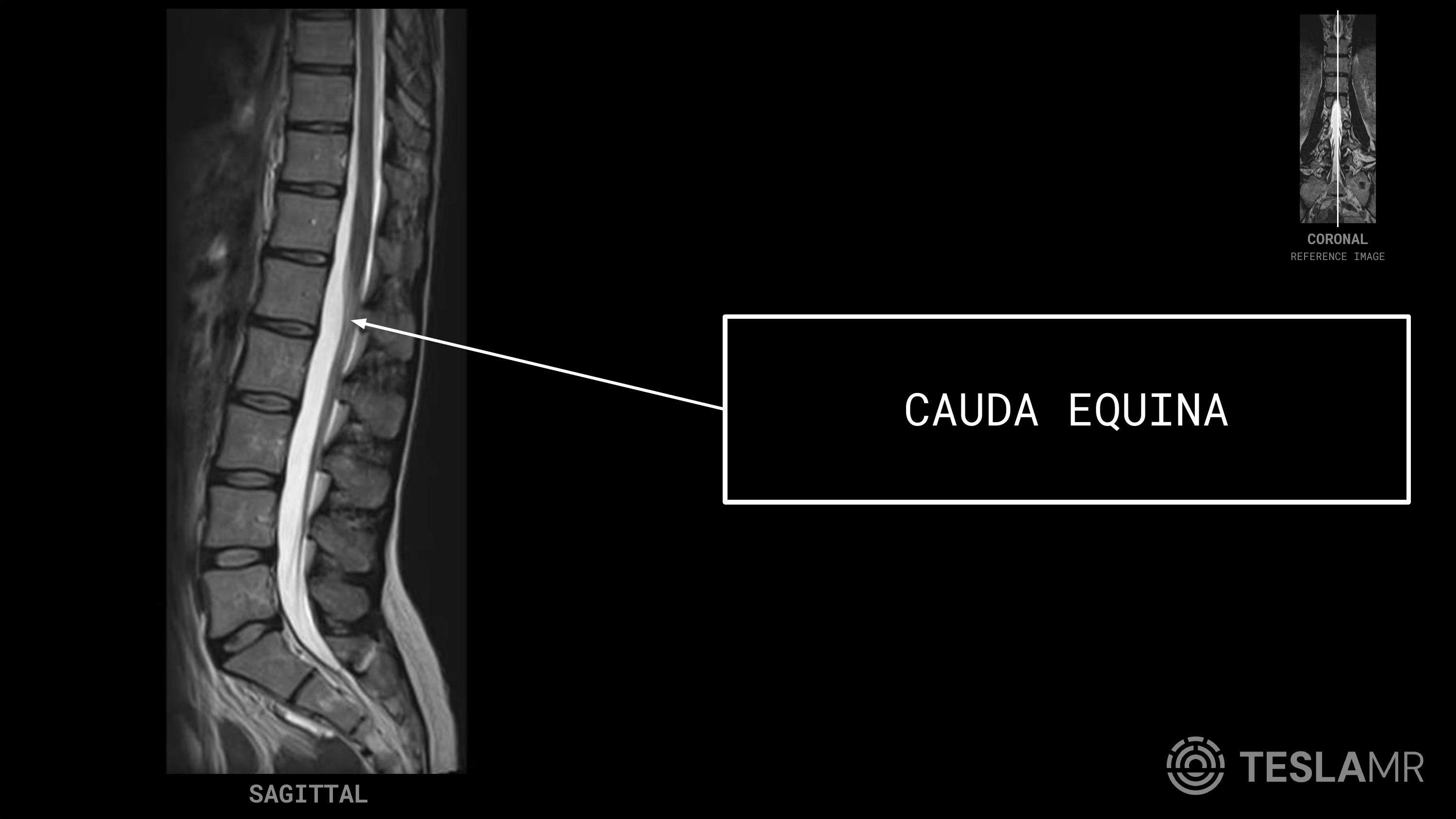 Cauda Equina labeled on a L-Spine MRI (Sagittal · Axial)