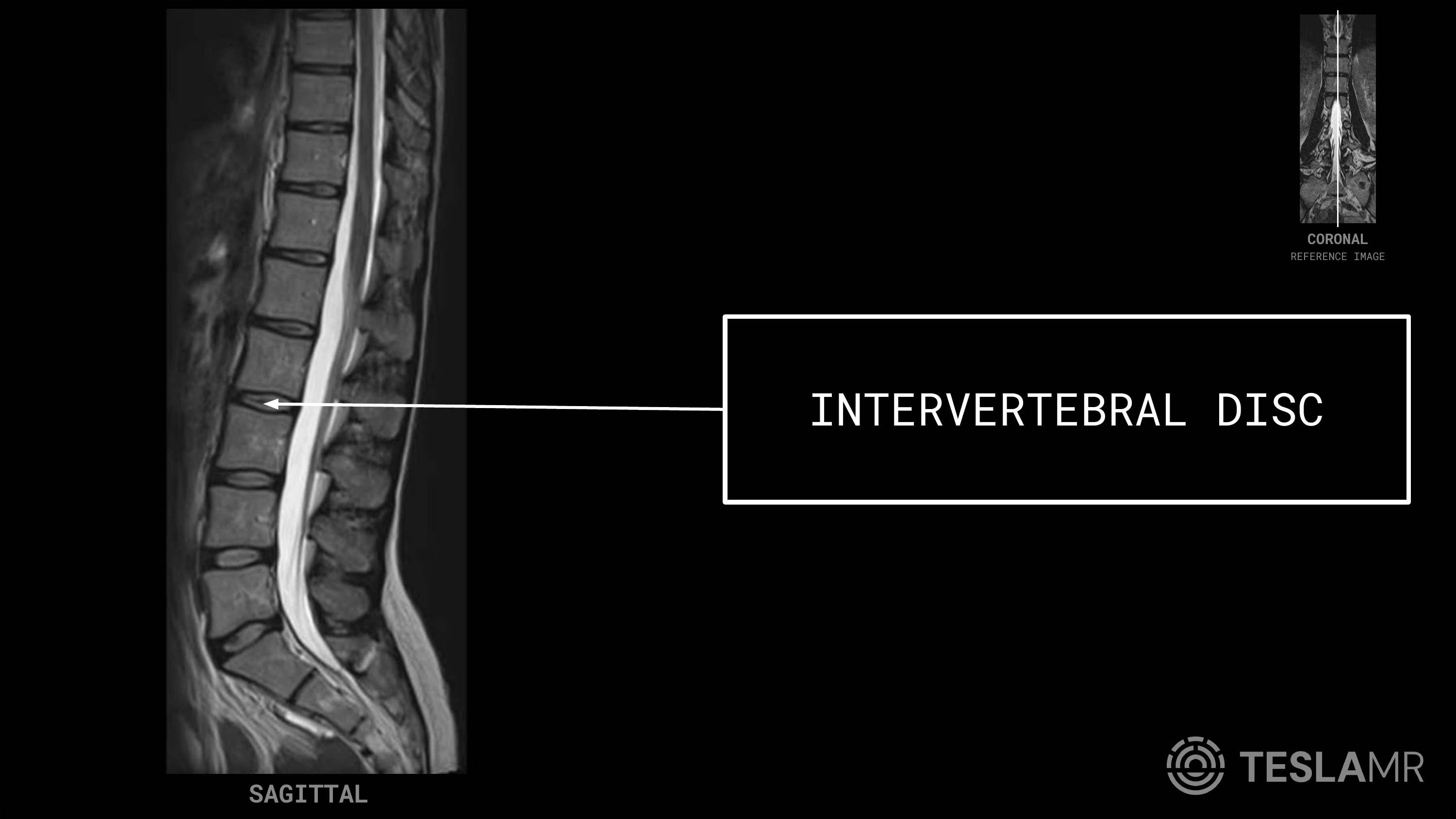 Intervertebral Disc labeled on a L-Spine MRI (Sagittal)