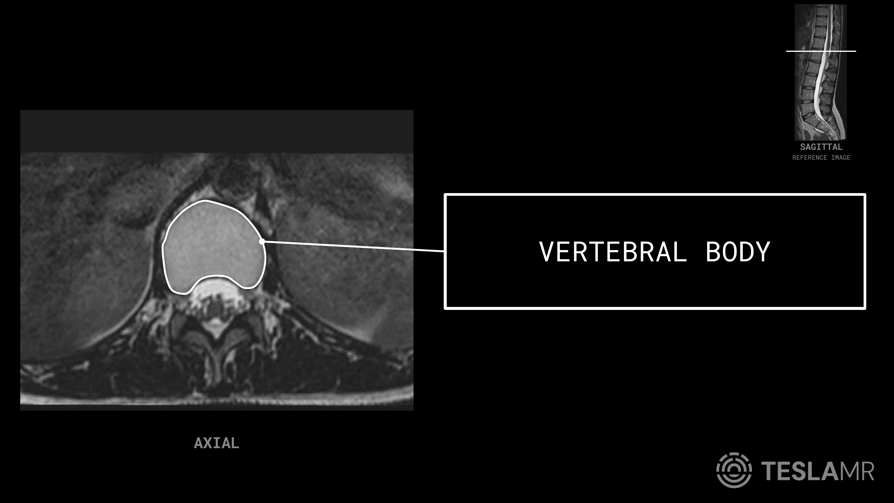 Vertebral Body labeled on a L-Spine MRI (Axial)