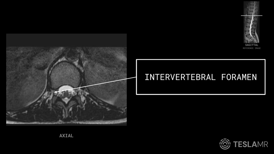 L Spine MRI Anatomy Labeled Images Structures Flashcards Tesla MR l-spine-mri-anatomy-labeled-images-structures-flashcards-tesla-mr