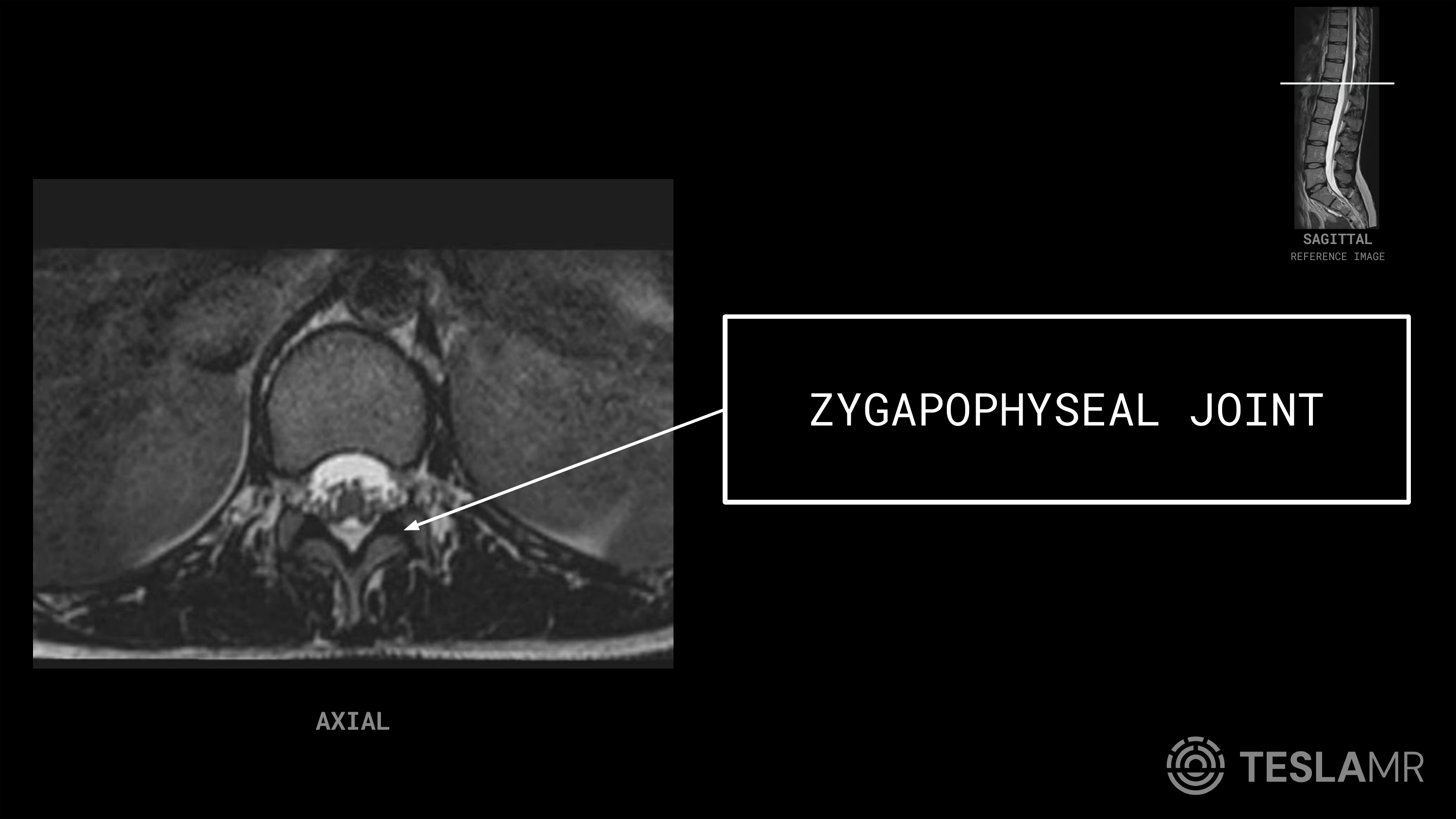 Zygapophyseal Joint labeled on a L-Spine MRI (Axial)