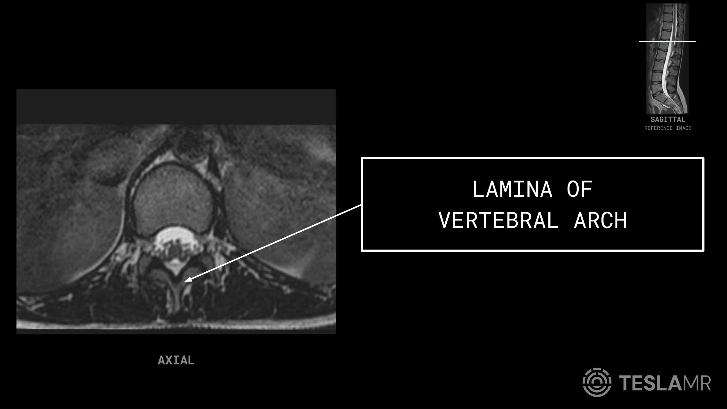 Lamina of Vertebral Arch labeled on a L-Spine MRI (Axial)