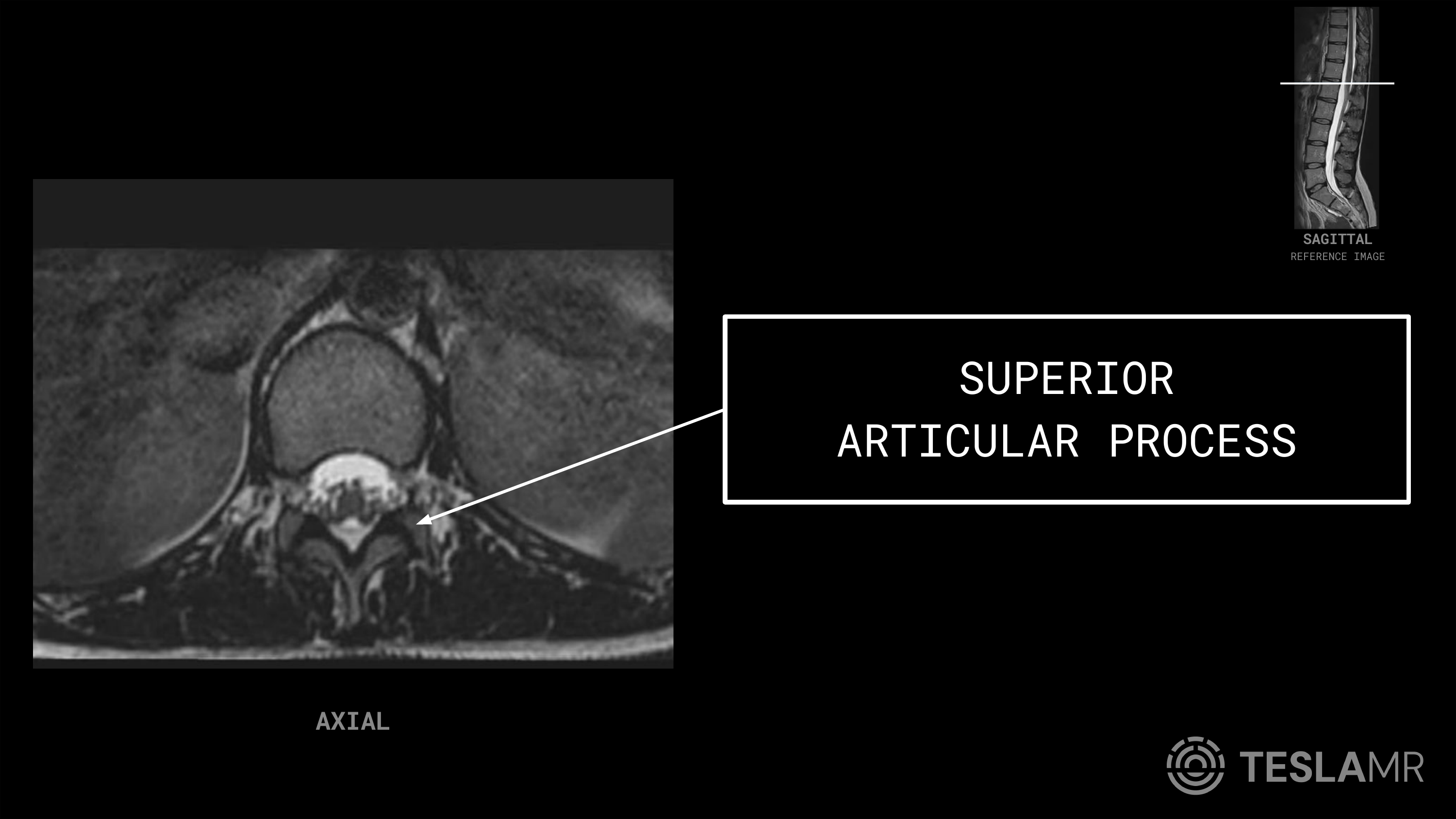 Superior Articular Process labeled on a L-Spine MRI (Axial)