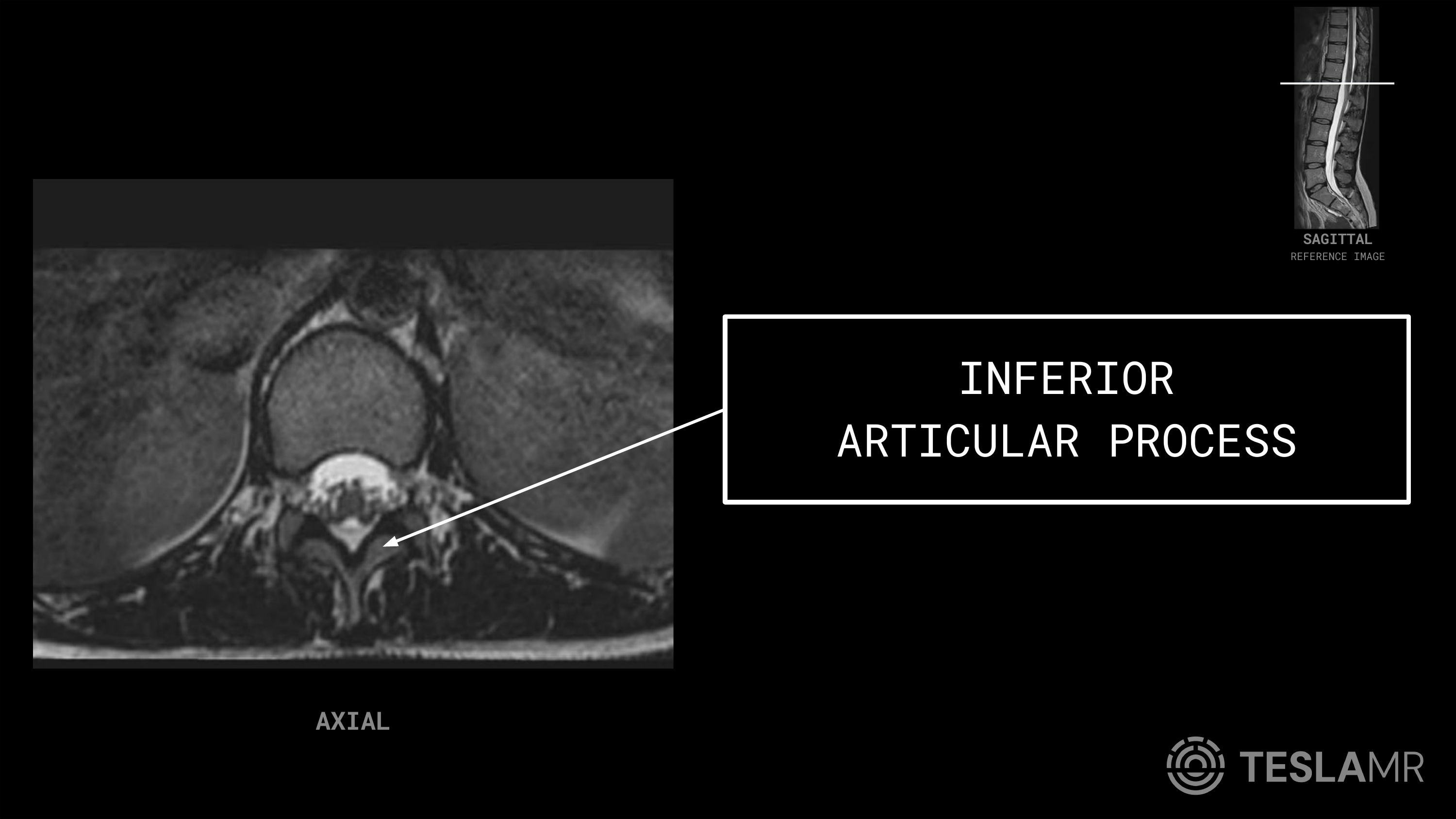 Inferior Articular Process labeled on a L-Spine MRI (Axial)