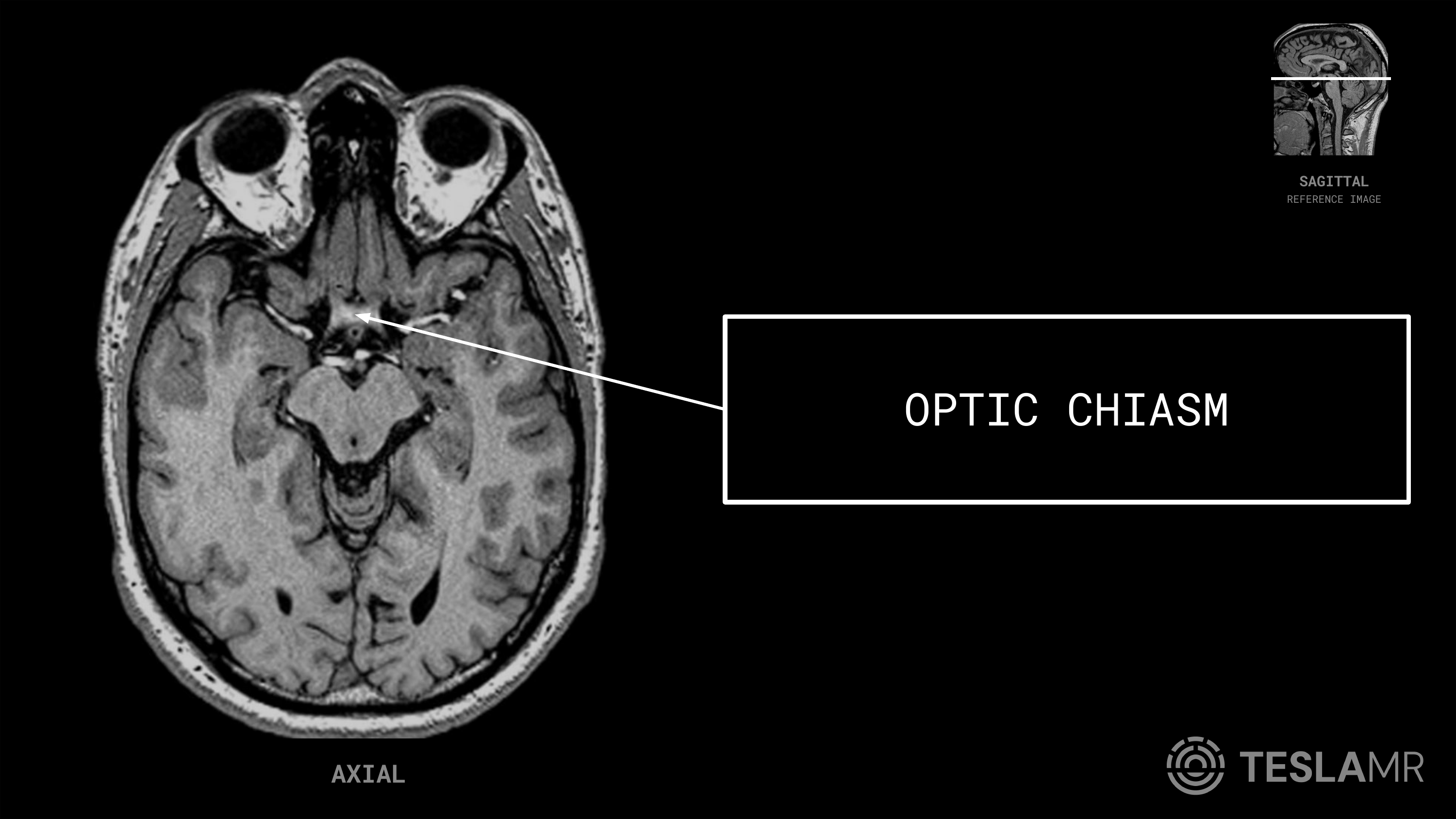 Optic Chiasm labeled on a Orbits MRI (Axial)