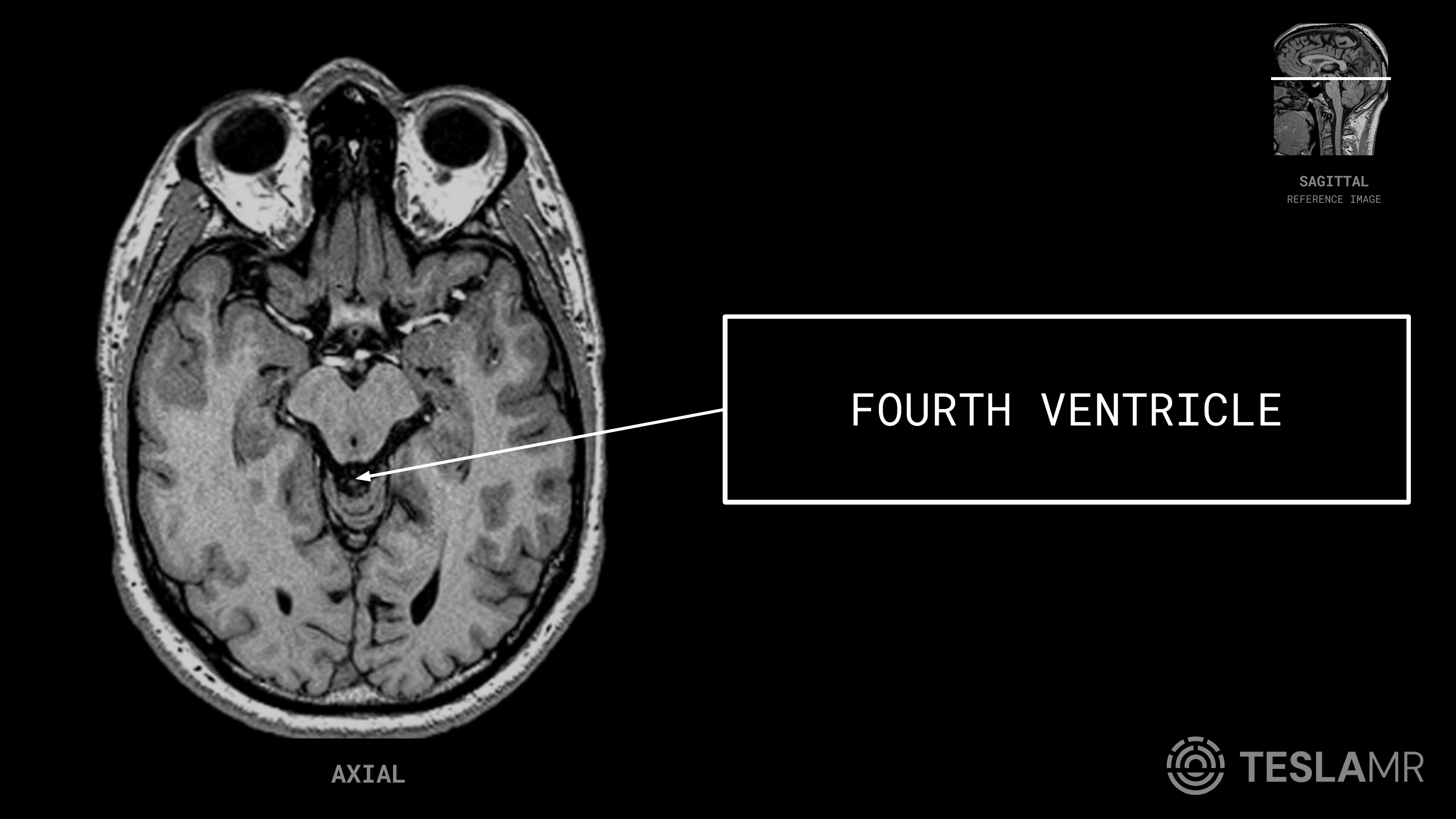 Fourth Ventricle labeled on a Orbits MRI (Axial)