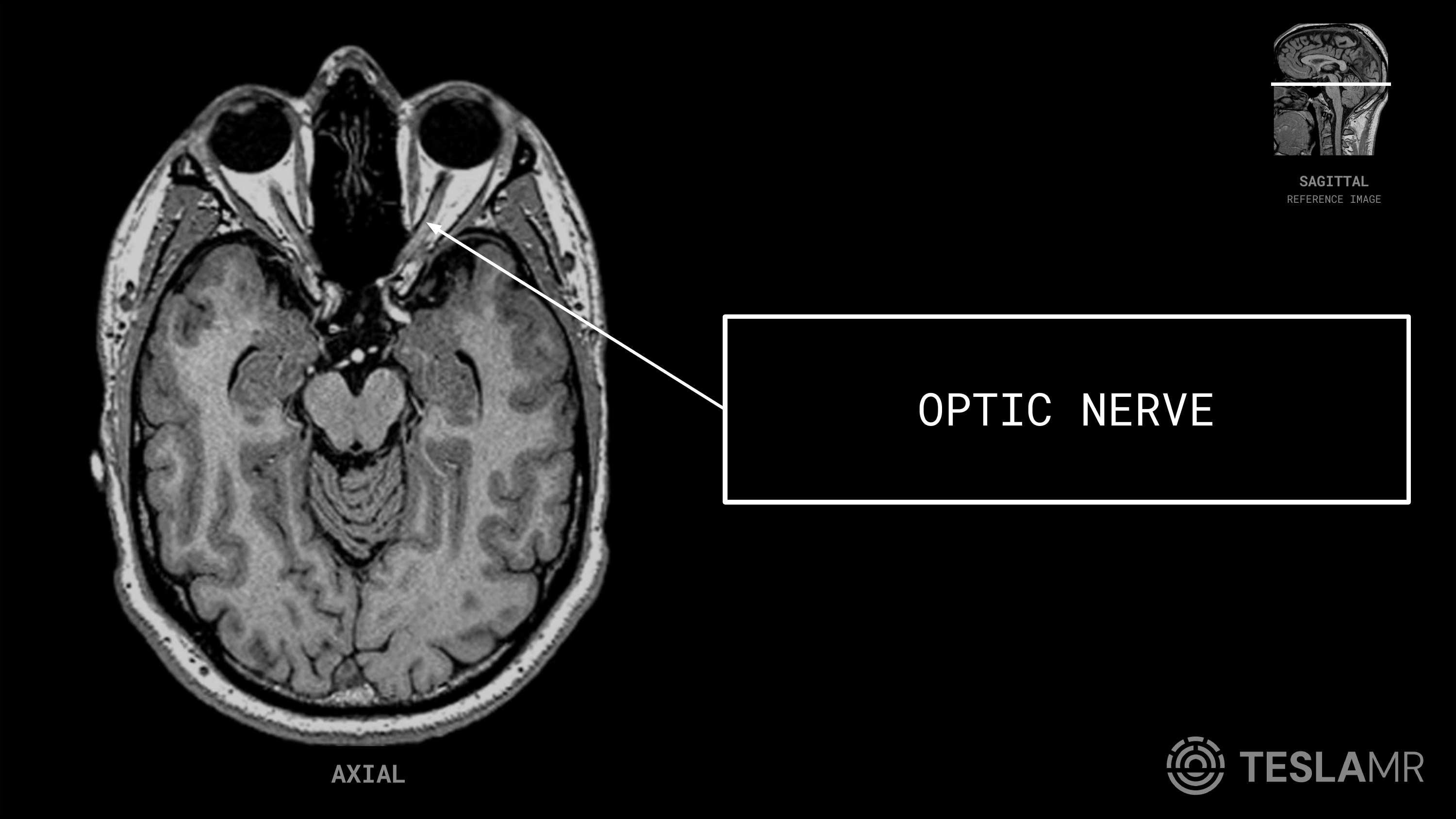 Optic Nerve labeled on a Orbits MRI (Axial · Sagittal Oblique)