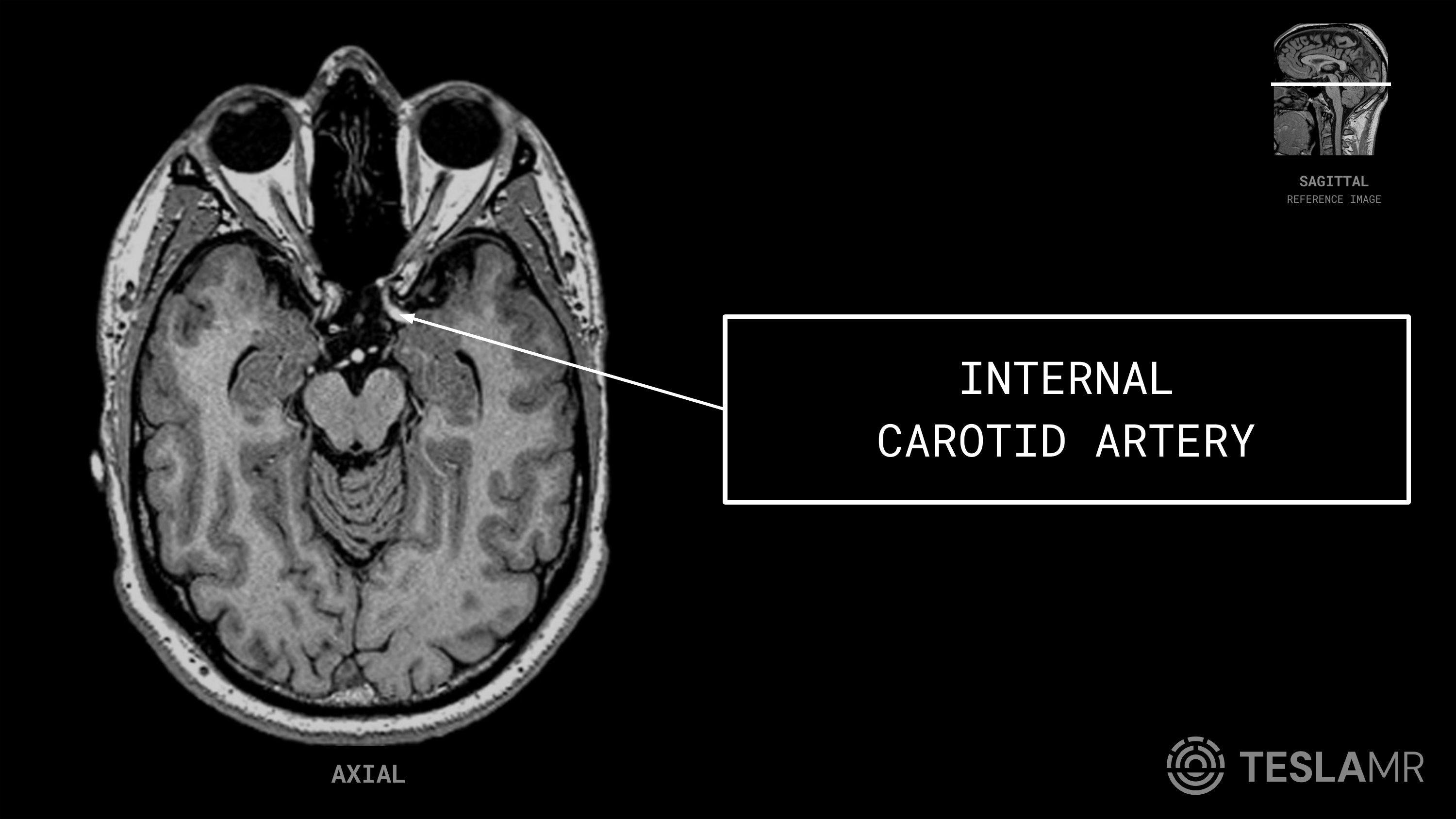 Internal Carotid Artery labeled on a Orbits MRI (Axial)