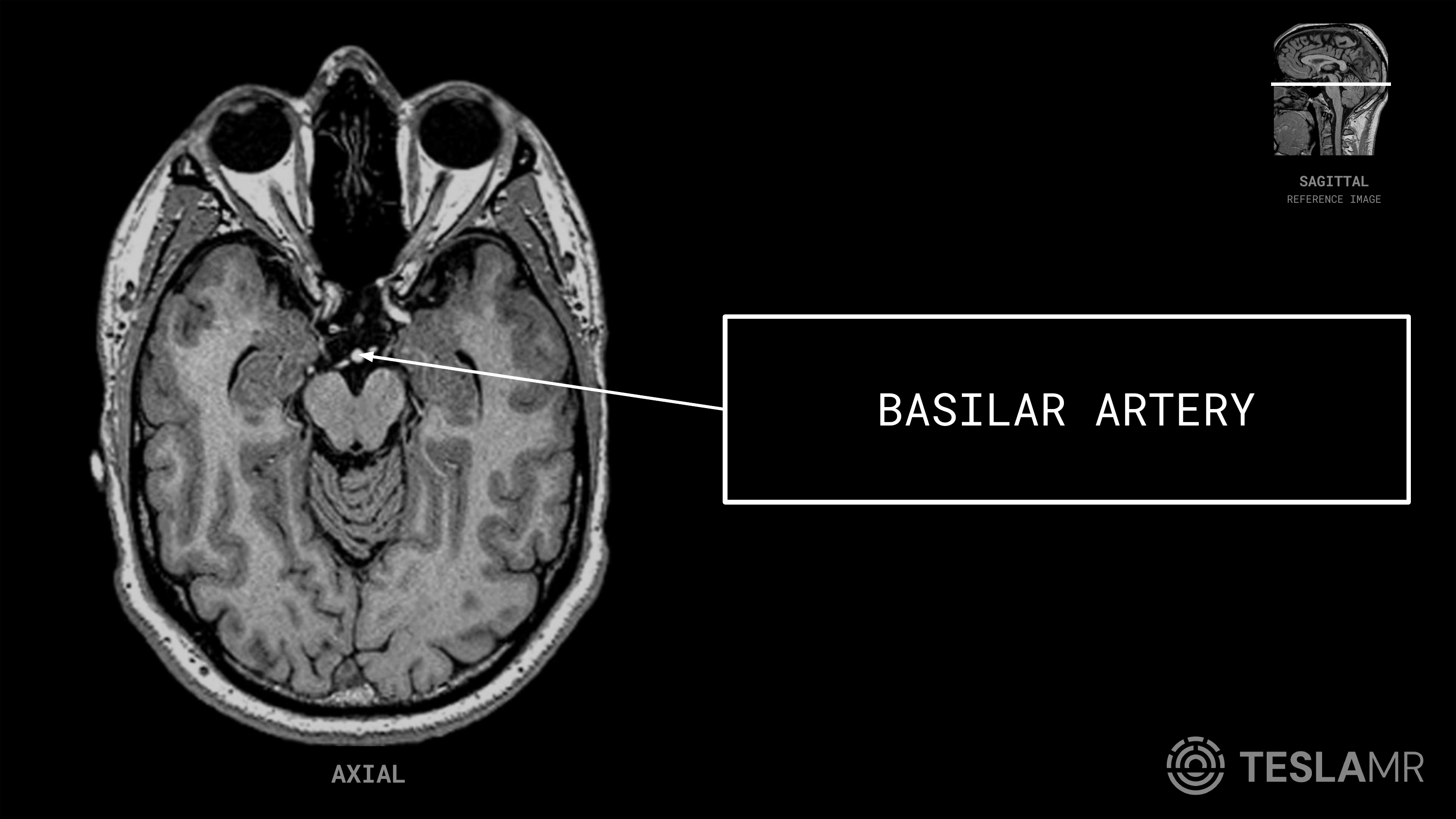 Basilar Artery labeled on a Orbits MRI (Axial)