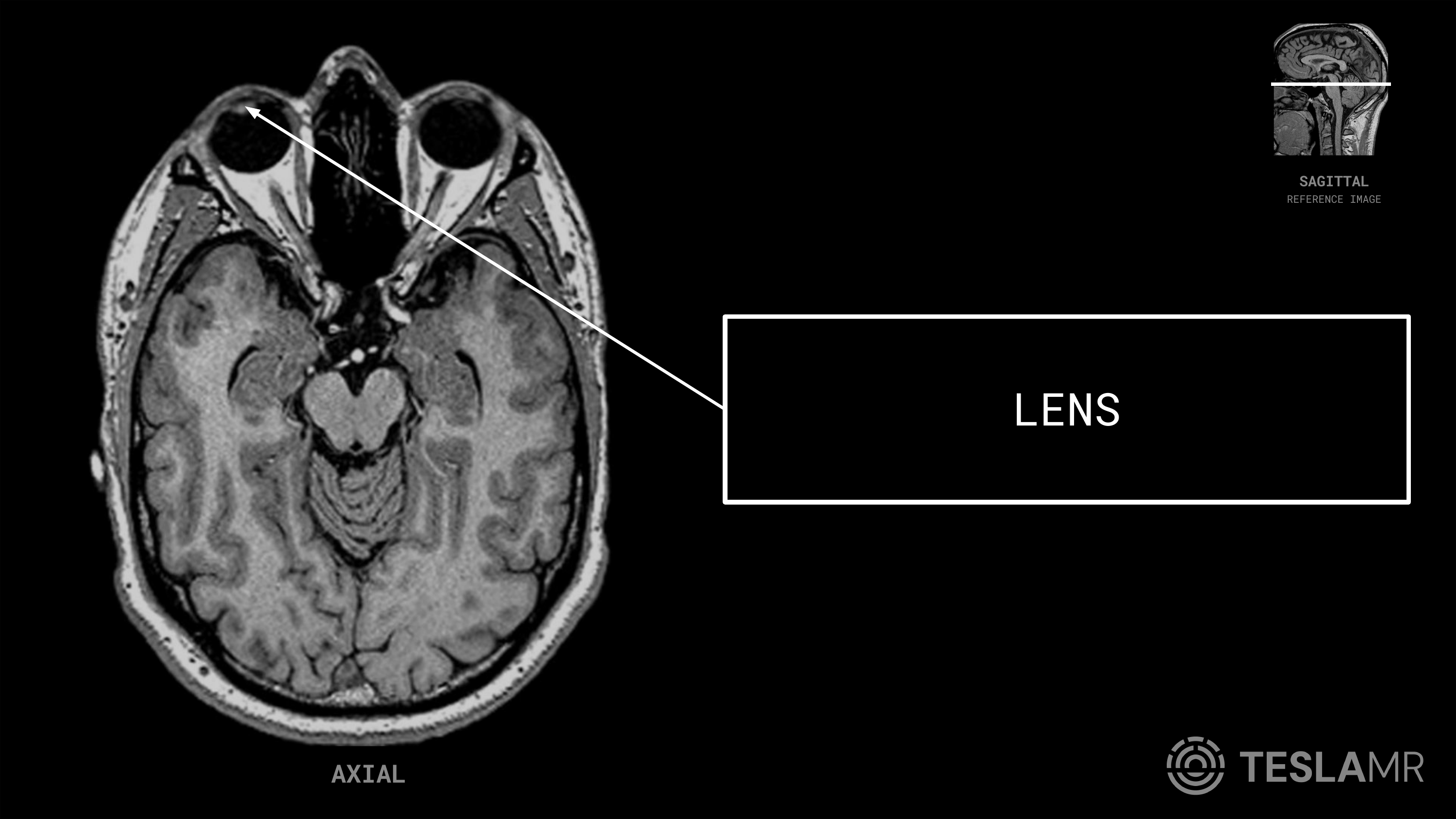 Lens labeled on a Orbits MRI (Axial · Sagittal Oblique)