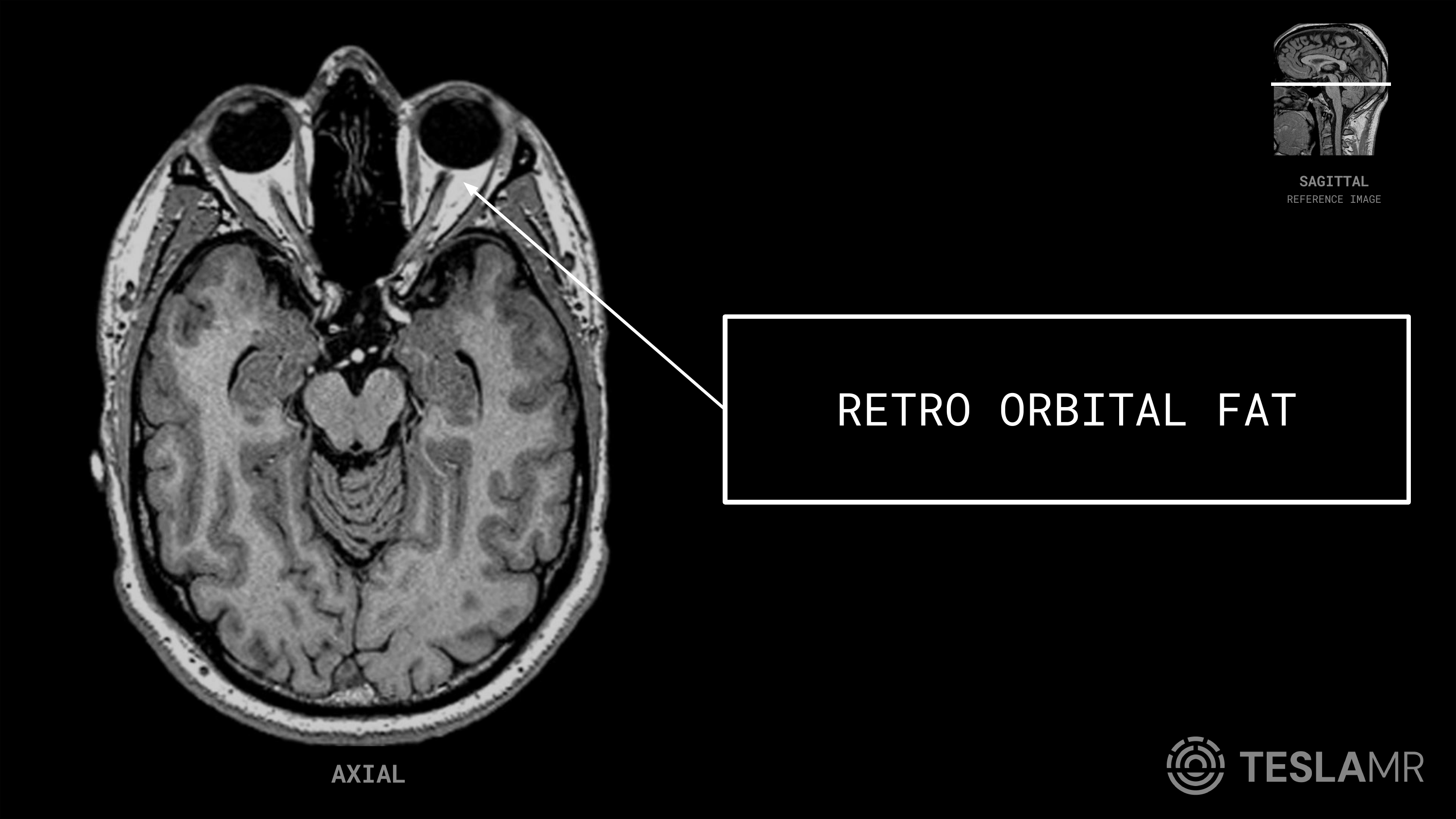Retro Orbital Fat labeled on a Orbits MRI (Axial)